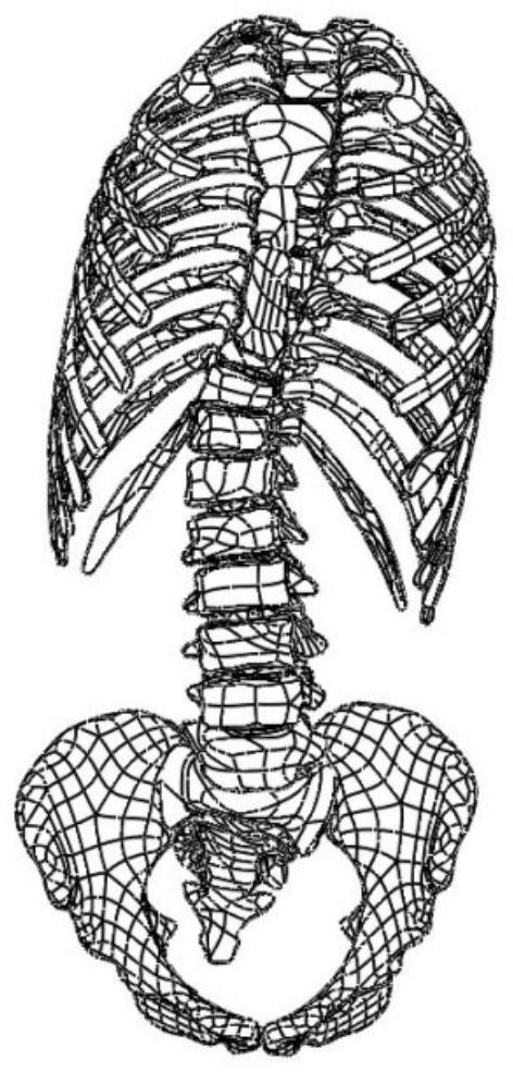 A design method of personalized 3D printed scoliosis orthosis