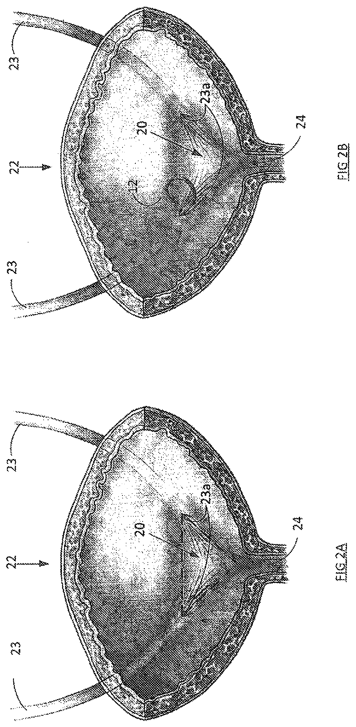 Stent and method of use