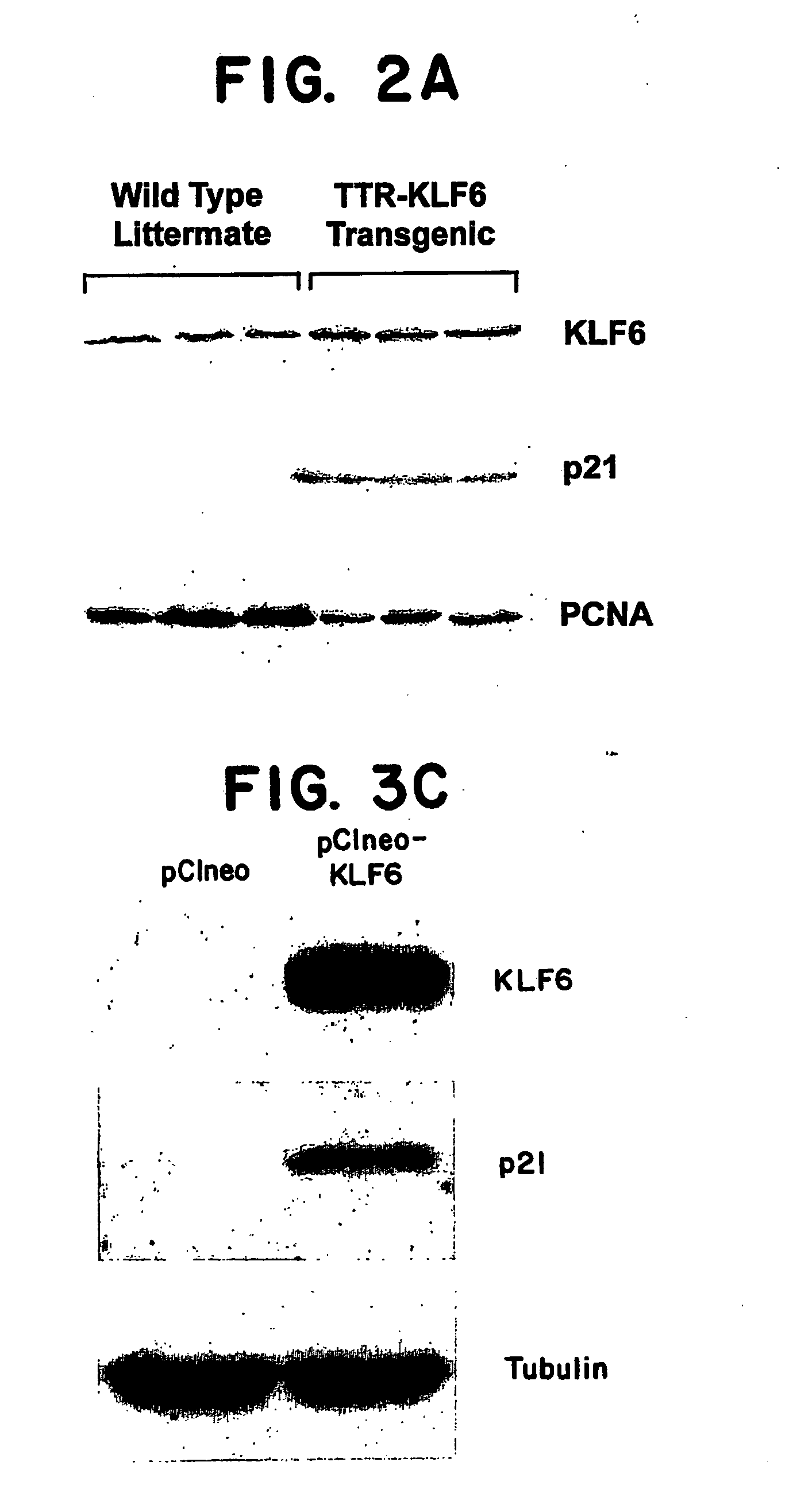 Kruppel-like factor 6 ( KLF6), a tumor suppressor protein, and diagnostics, therapeutics, and screening based on this protein