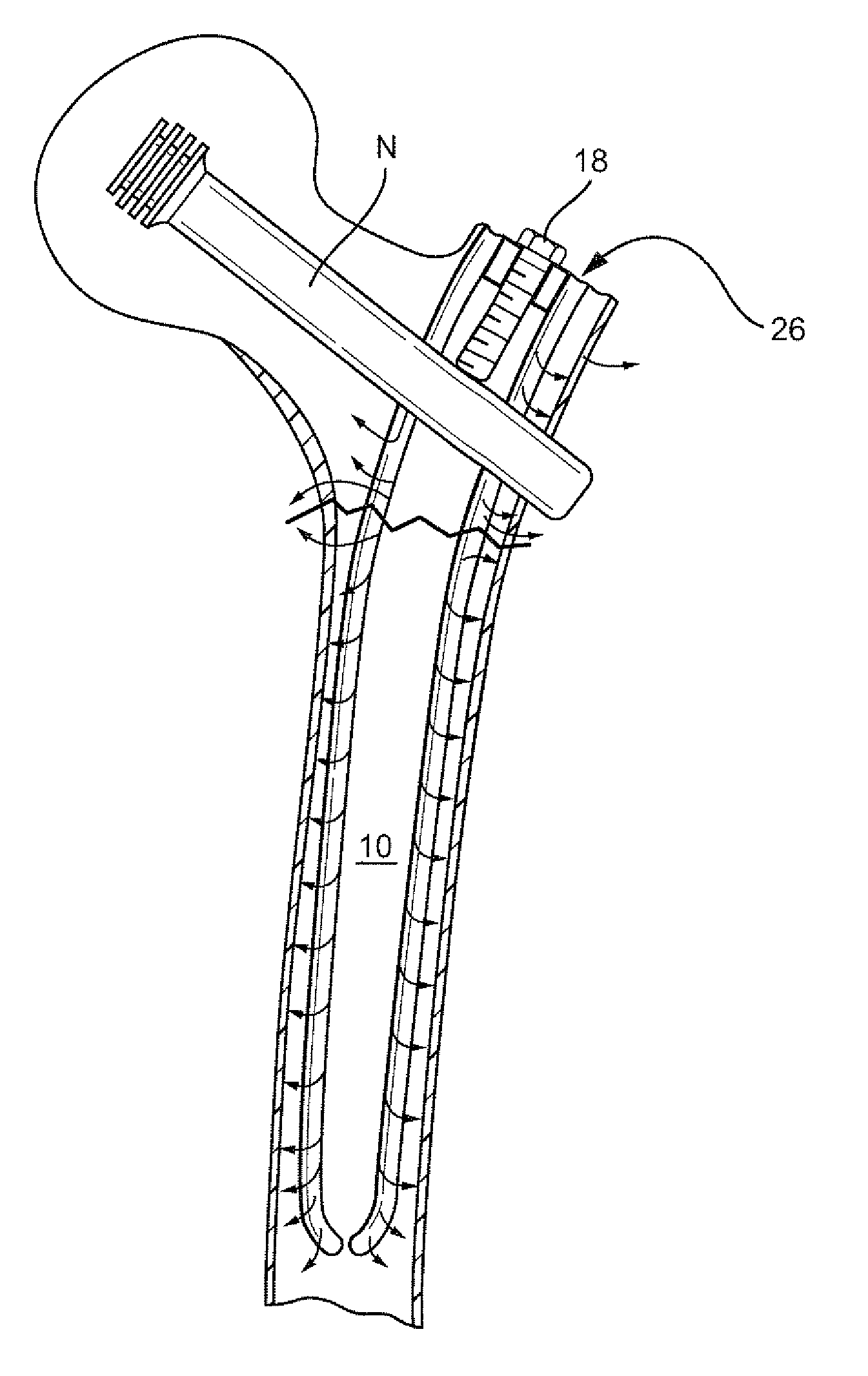 Biologic Intramedullary Fixation Device and Methods of Use