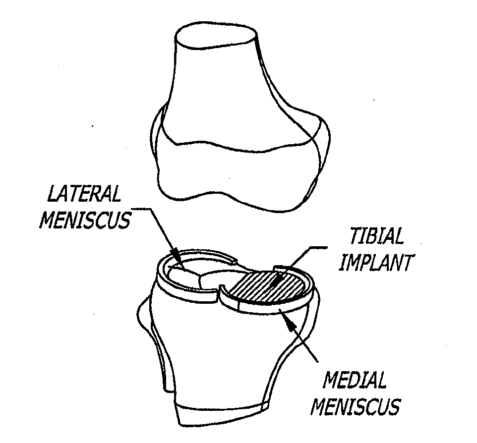 Knee joint prosthesis and hyaluronate compositions for treatment of osteoarthritis