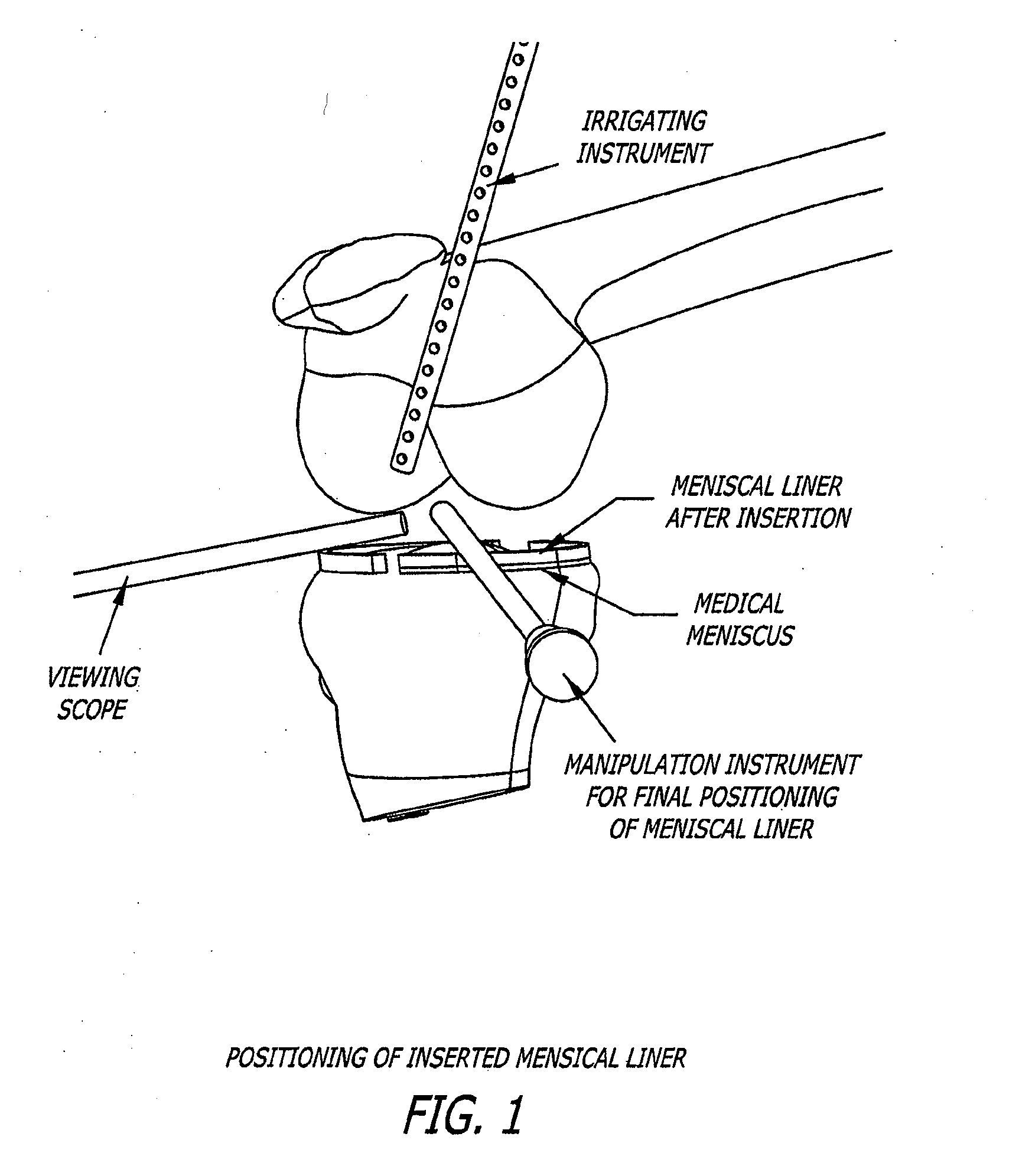 Knee joint prosthesis and hyaluronate compositions for treatment of osteoarthritis