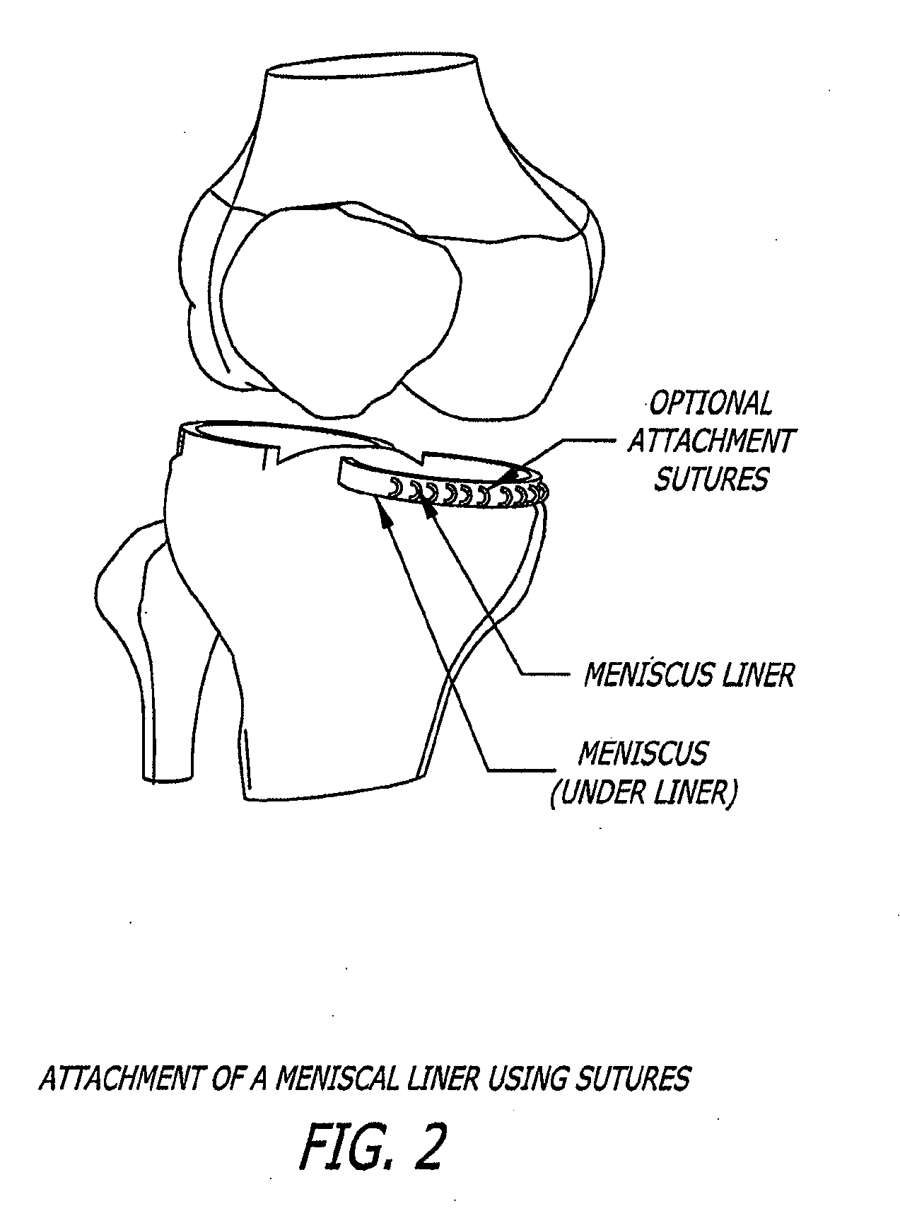 Knee joint prosthesis and hyaluronate compositions for treatment of osteoarthritis