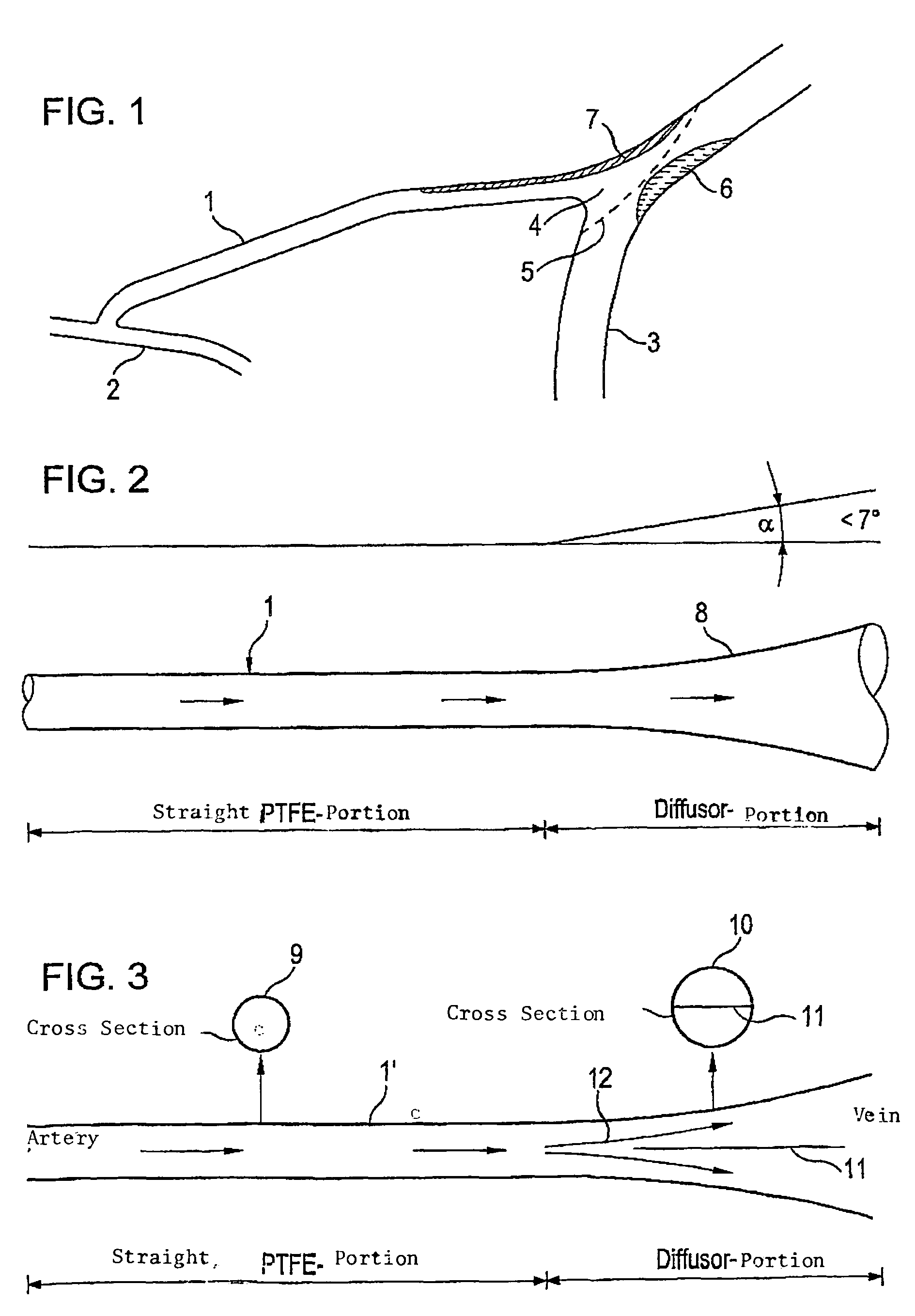 Tubular vascular transplant