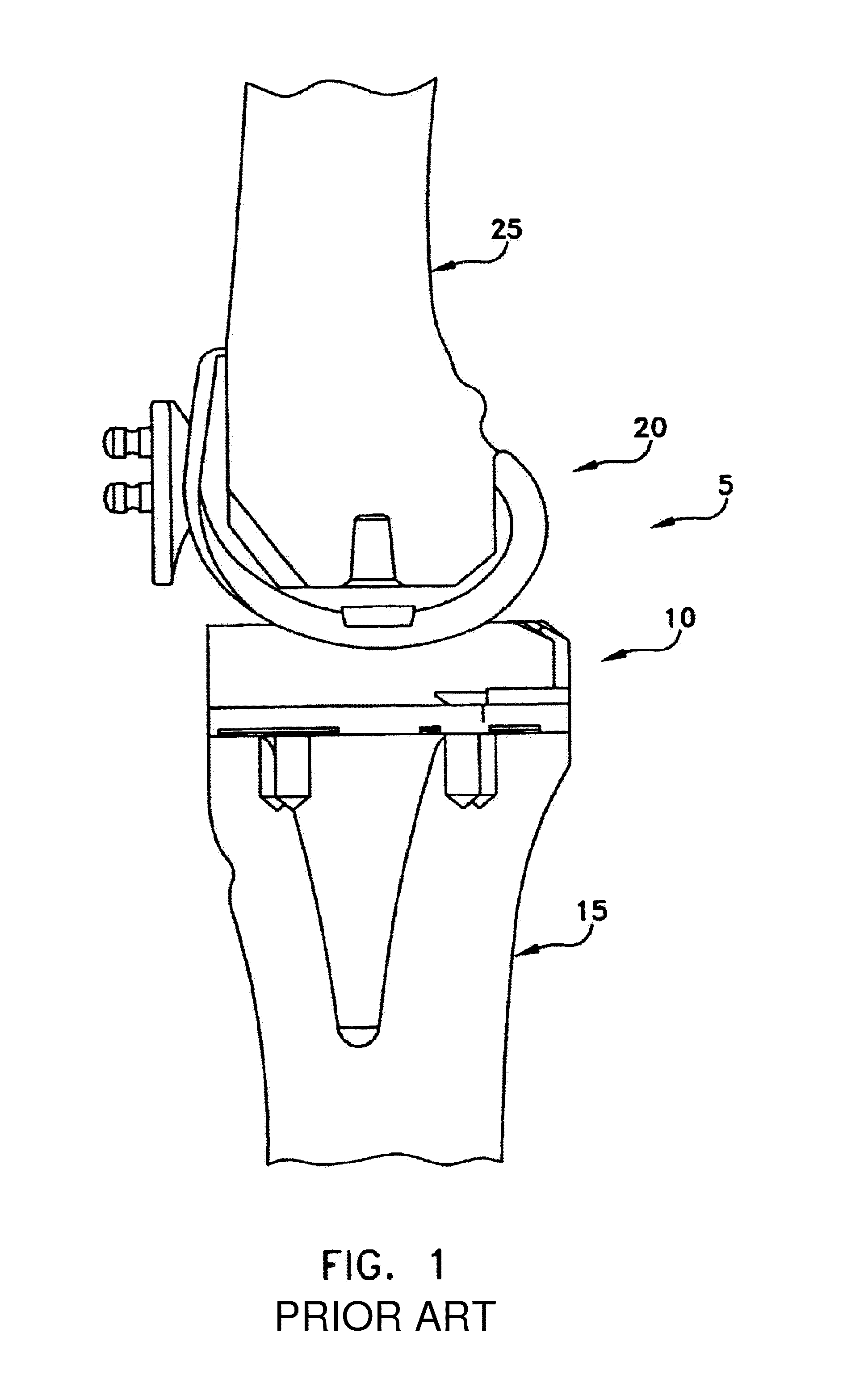 Tibial baseplate assembly for knee joint prosthesis
