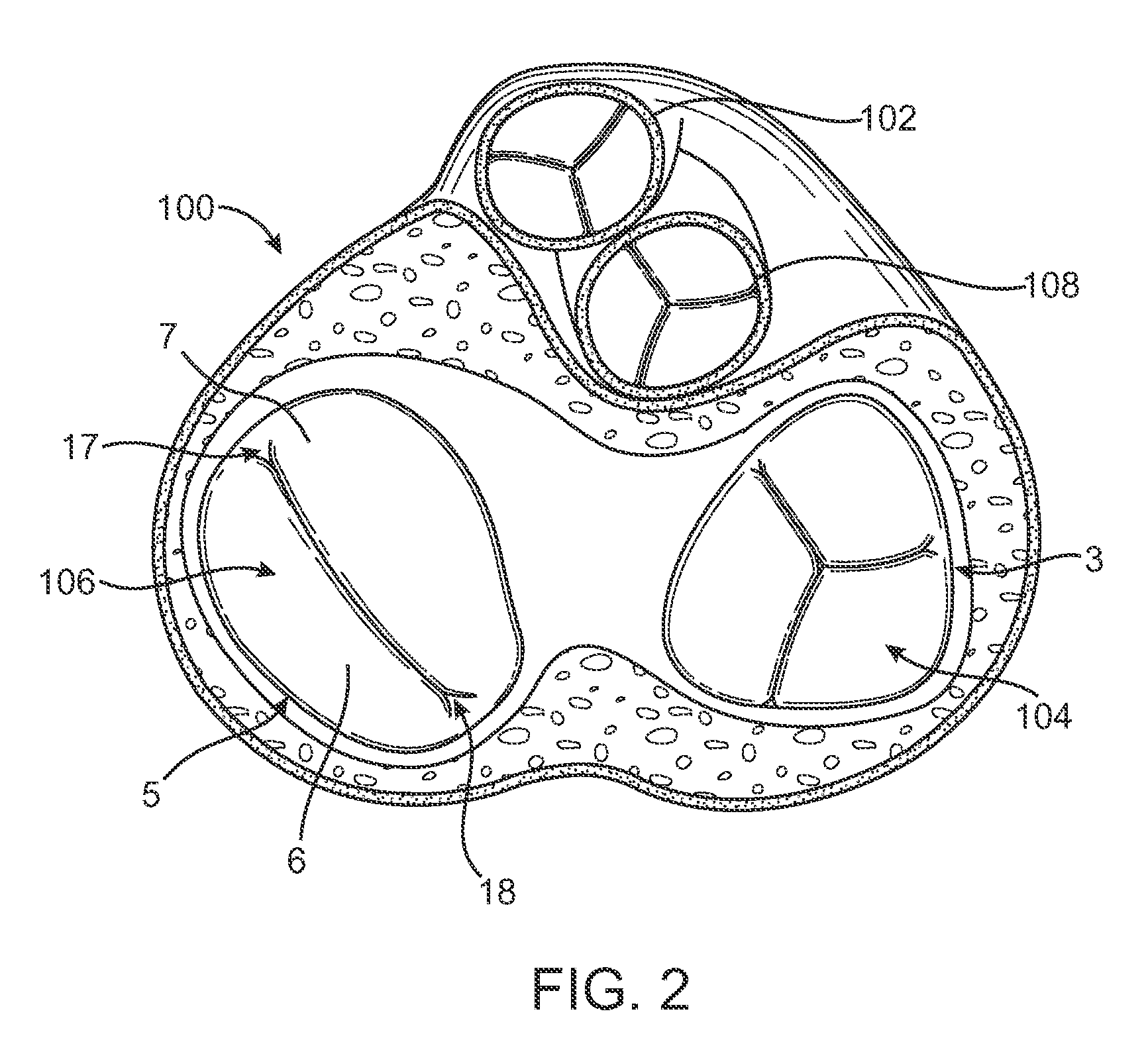 Articulating Tip Tetherless Catheter System