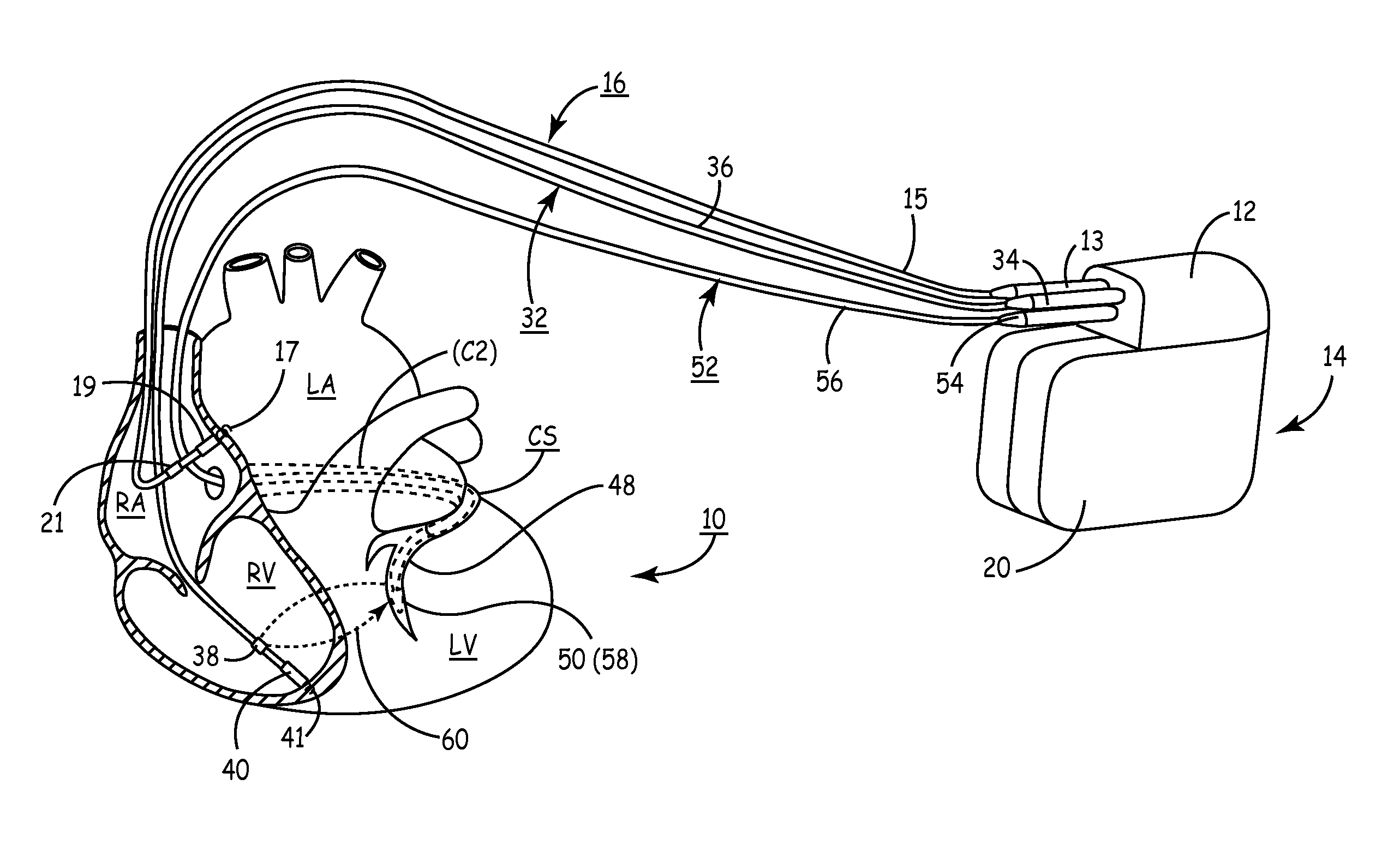 Implantable medical device for cardiac electrical stimulation