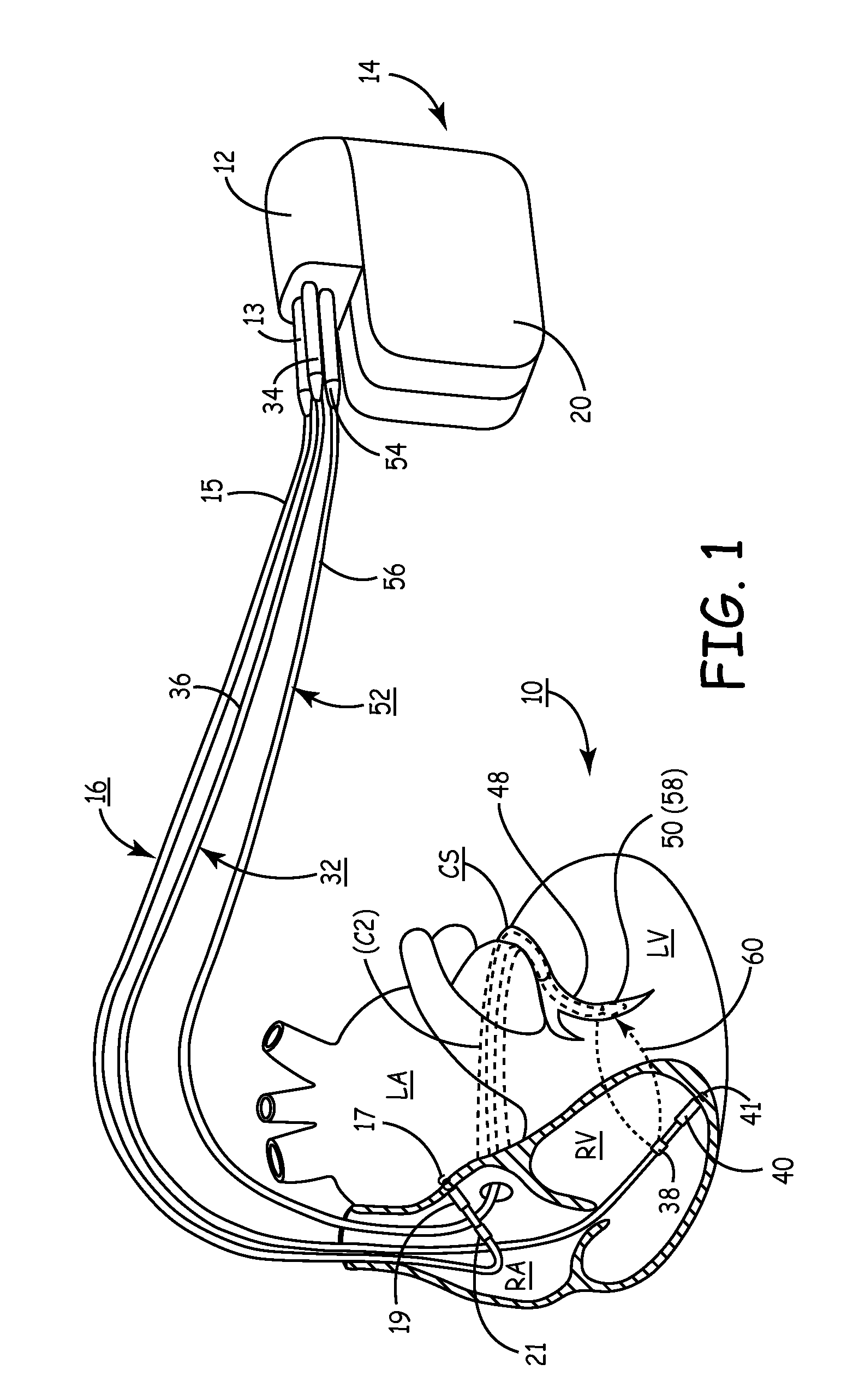 Implantable medical device for cardiac electrical stimulation