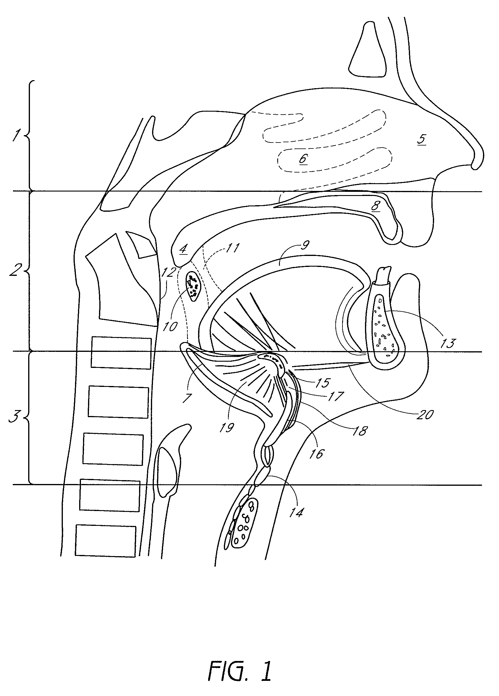 System and method for temporary tongue suspension