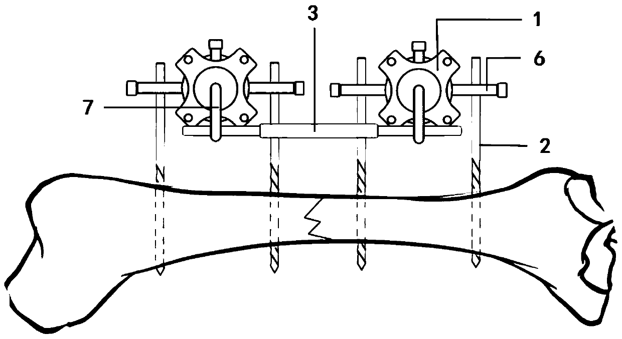 External fixator for limb fractures