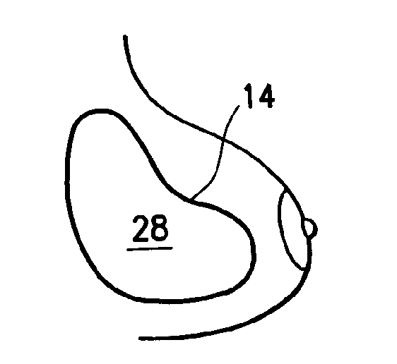 Tissue marking implant