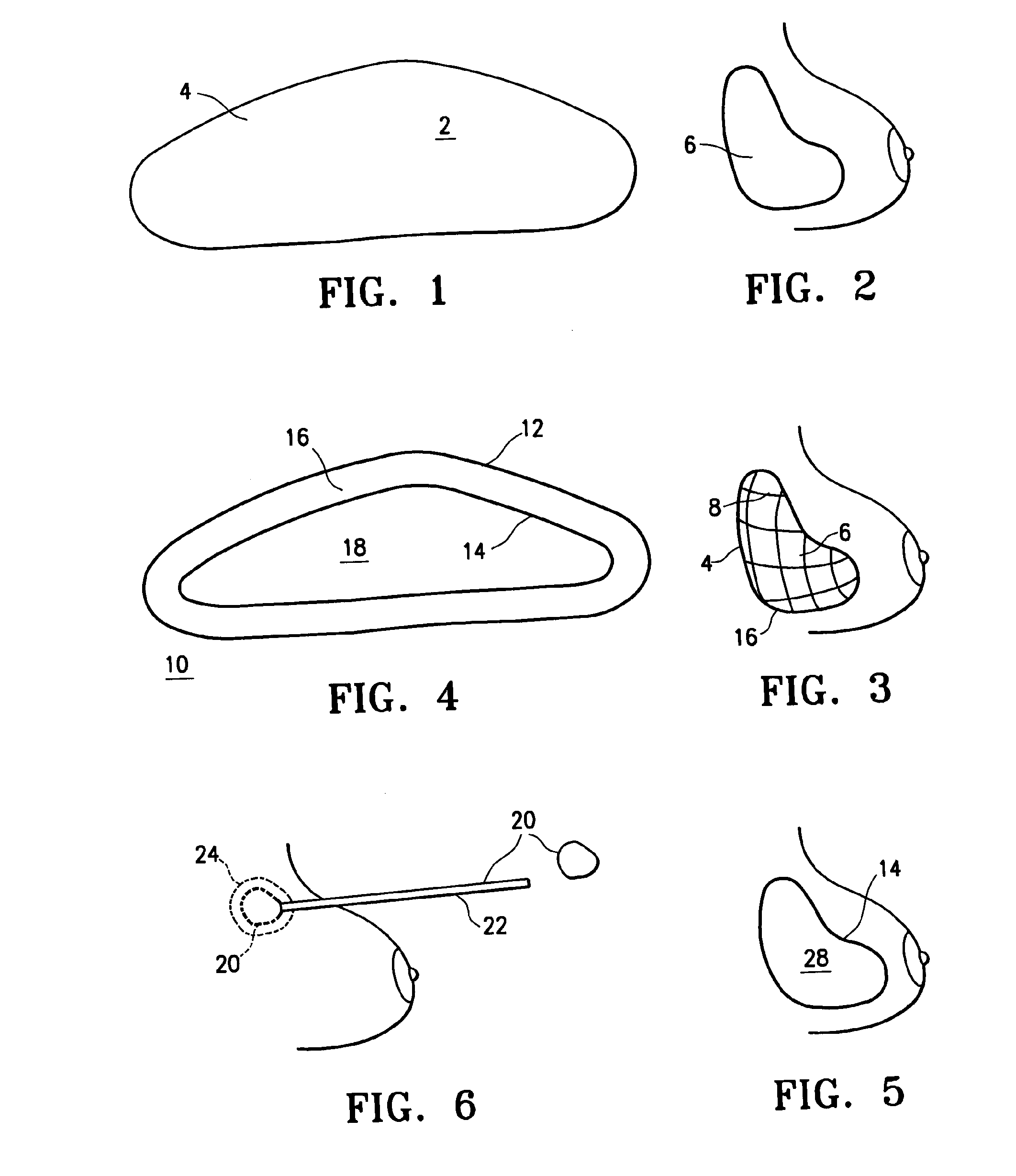 Tissue marking implant