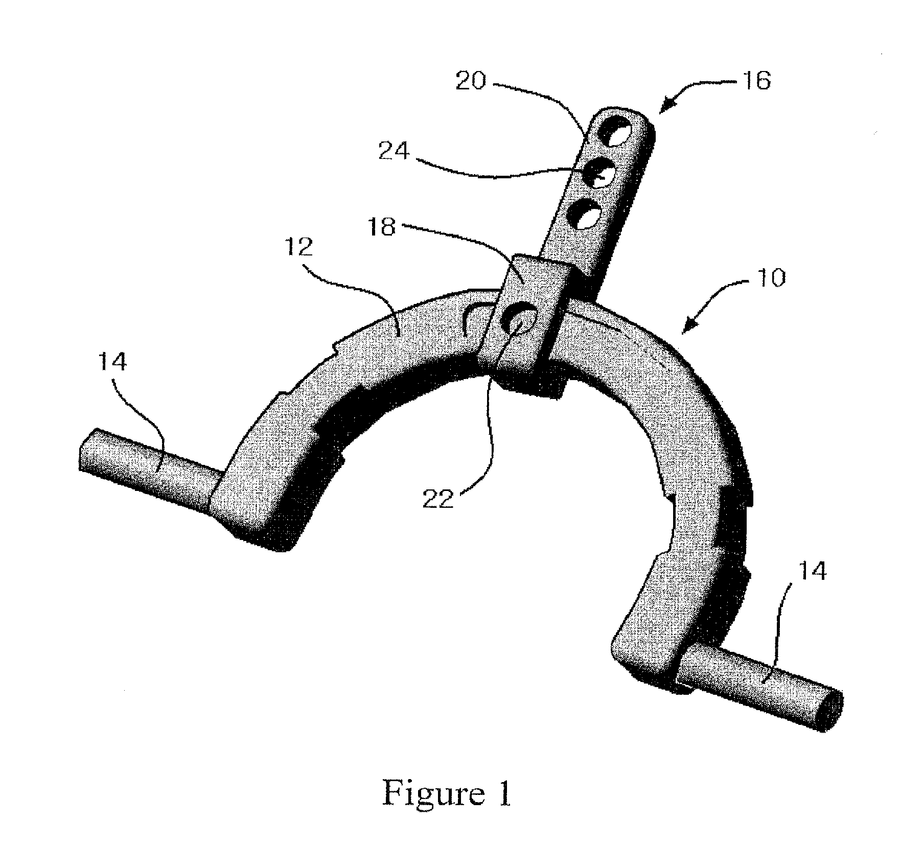 Apparatus for Occipital-Cervical Fixation Enabling Supplemental Occipital Bone Fixation