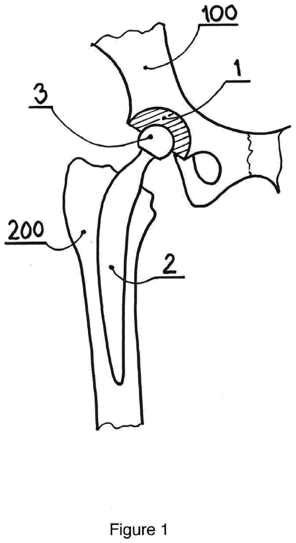 Resurfacing  cup for acetabulum hemiarthroplasty of the hip joint