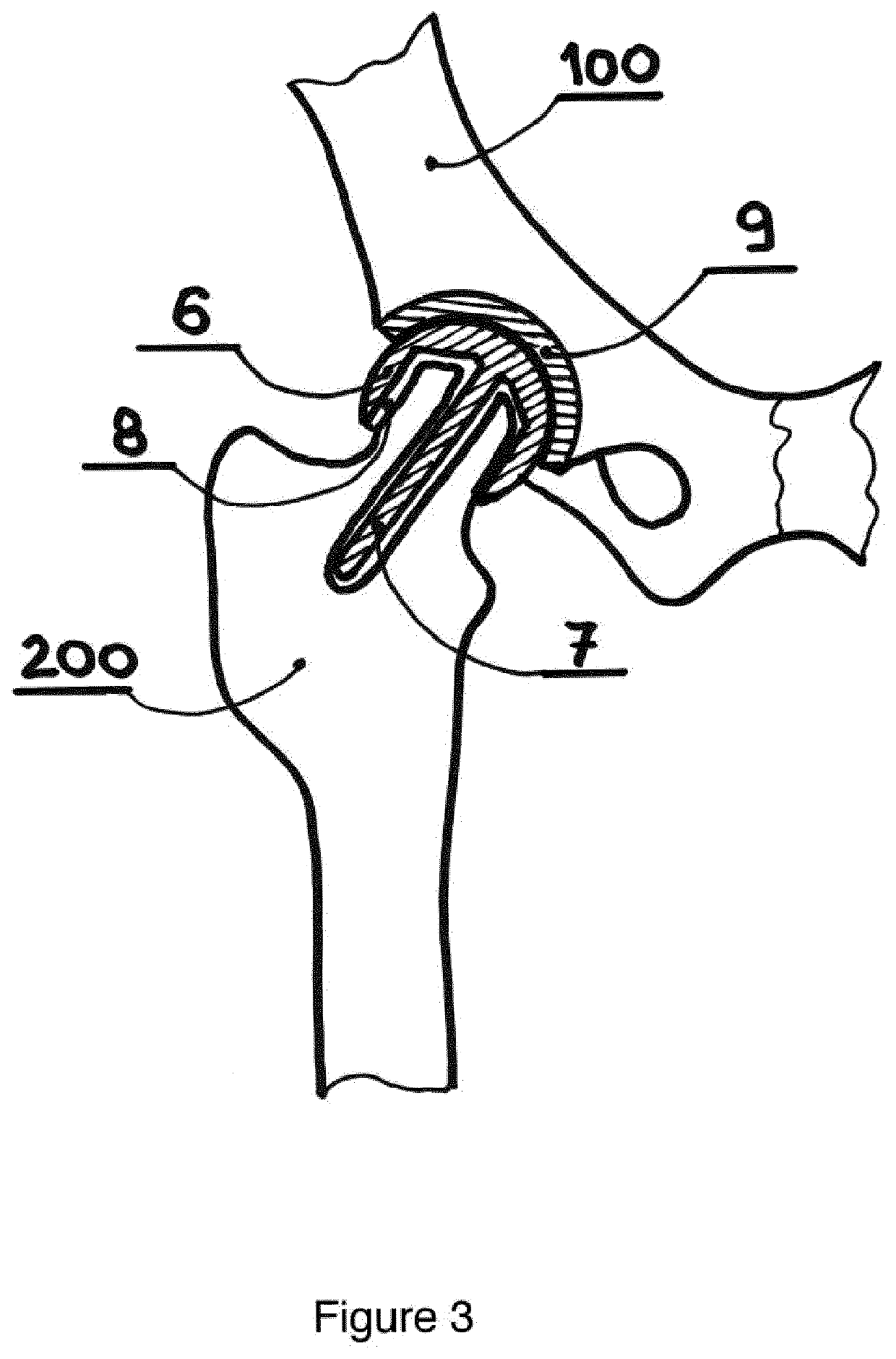 Resurfacing  cup for acetabulum hemiarthroplasty of the hip joint