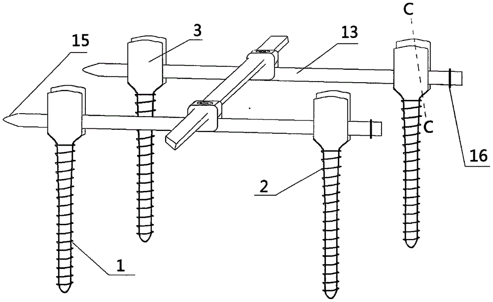 Posterior minimally invasive screw-rod system for thoracolumbar vertebral fracture