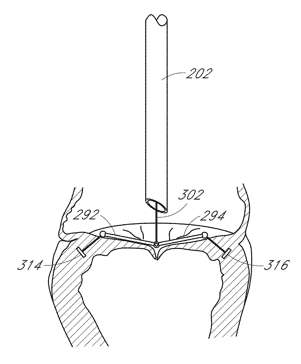 Percutaneous delivery systems for anchoring an implant in a cardiac valve annulus