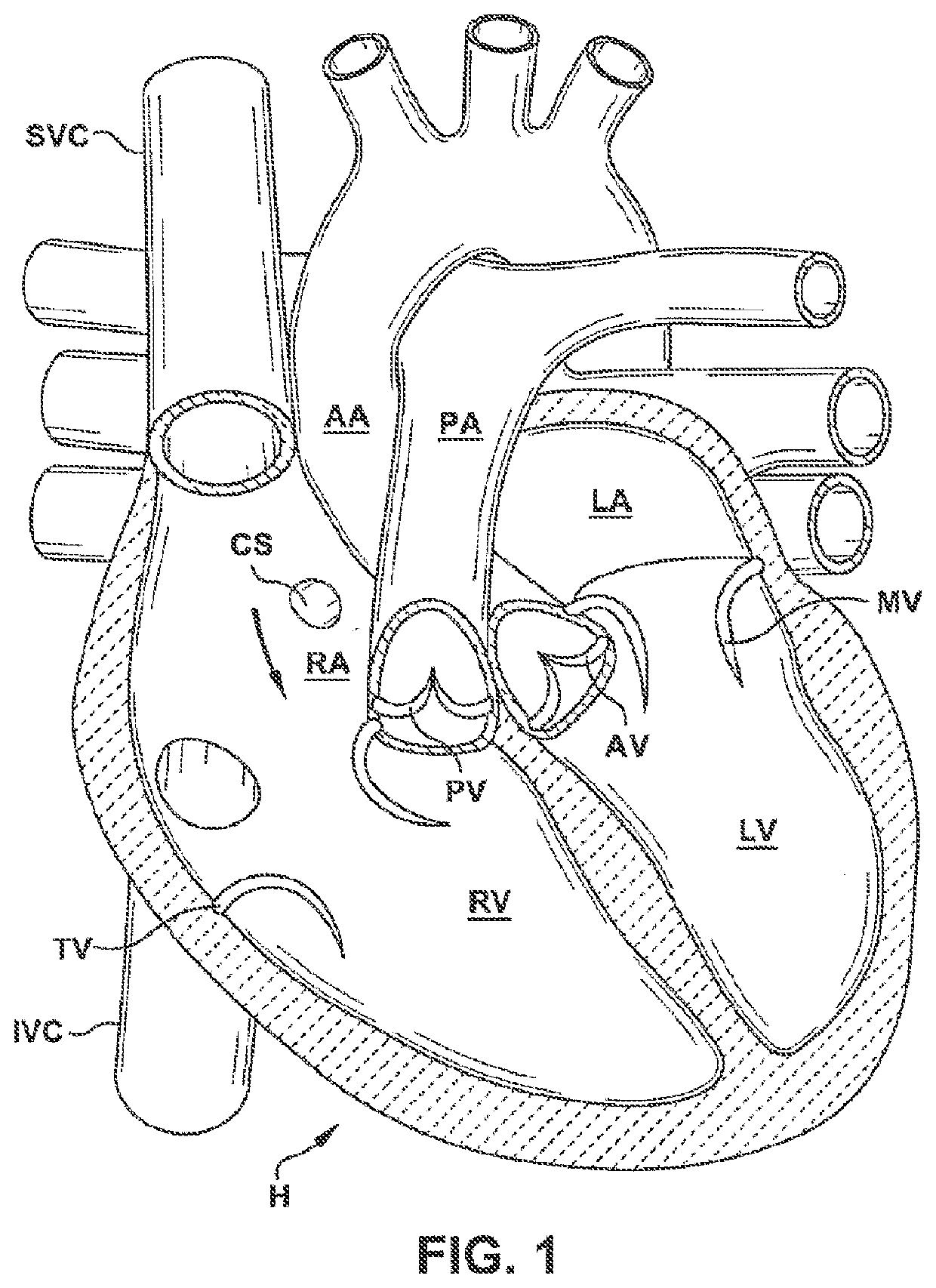 Valve repair devices for repairing a native valve of a patient