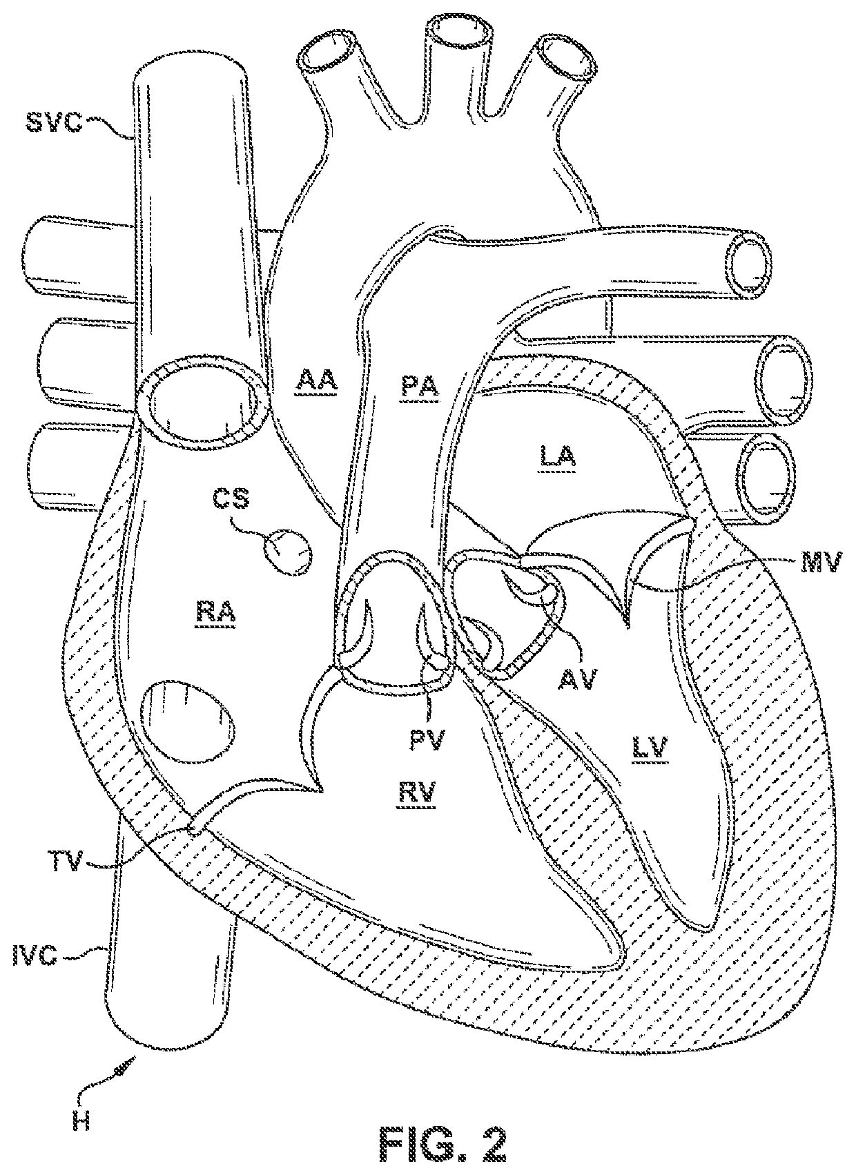 Valve repair devices for repairing a native valve of a patient