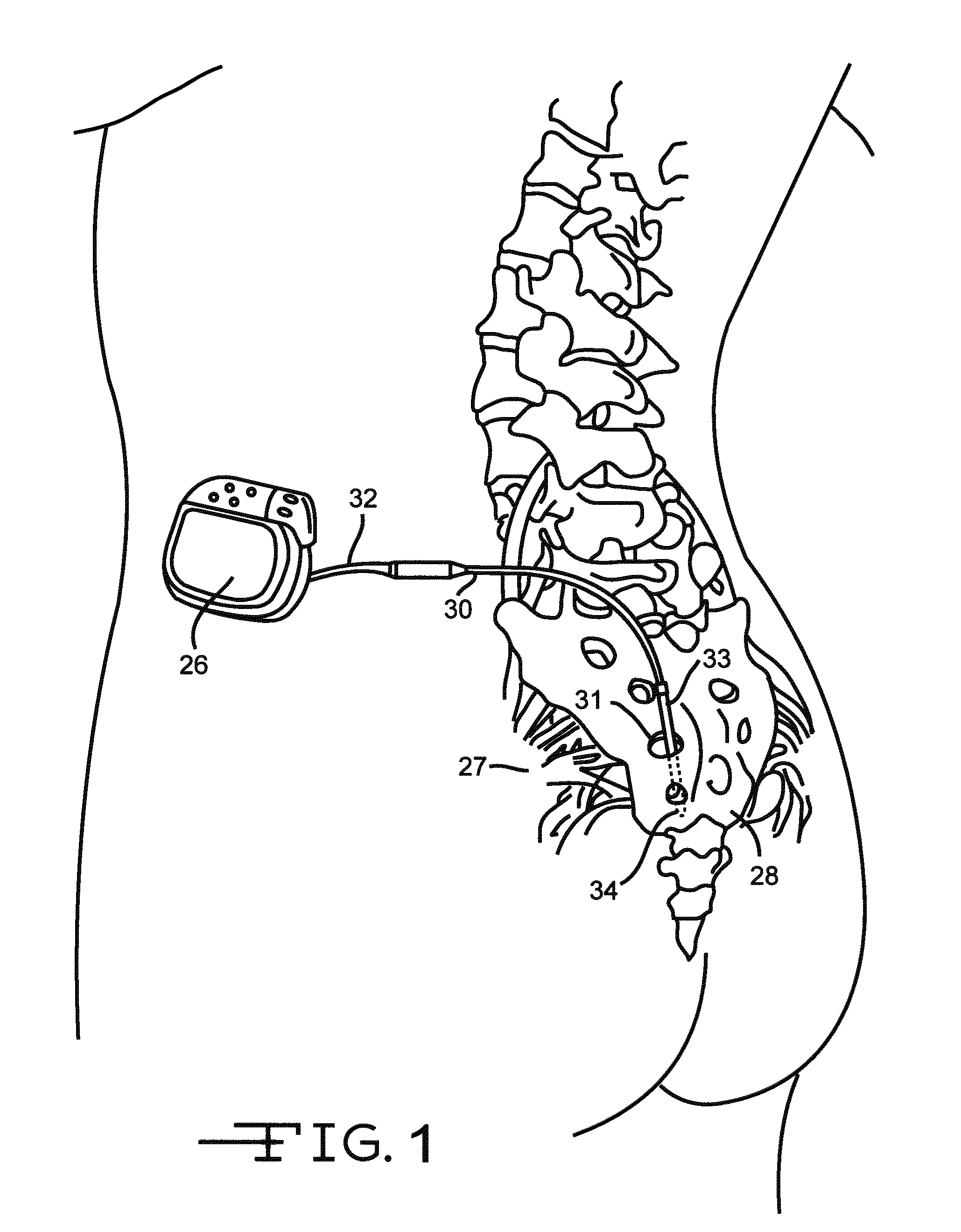 Minimally invasive methods for implanting a sacral stimulation lead