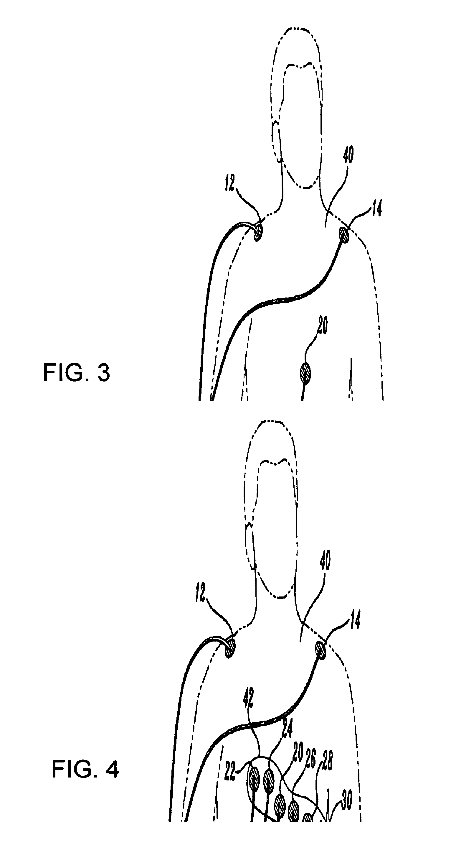 Wireless electrode arrangement and method for patient monitoring via electrocardiography