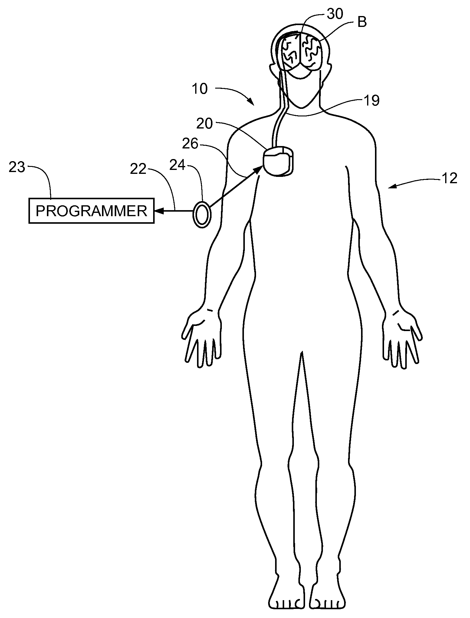 Method and apparatus for detection of nervous system disorders