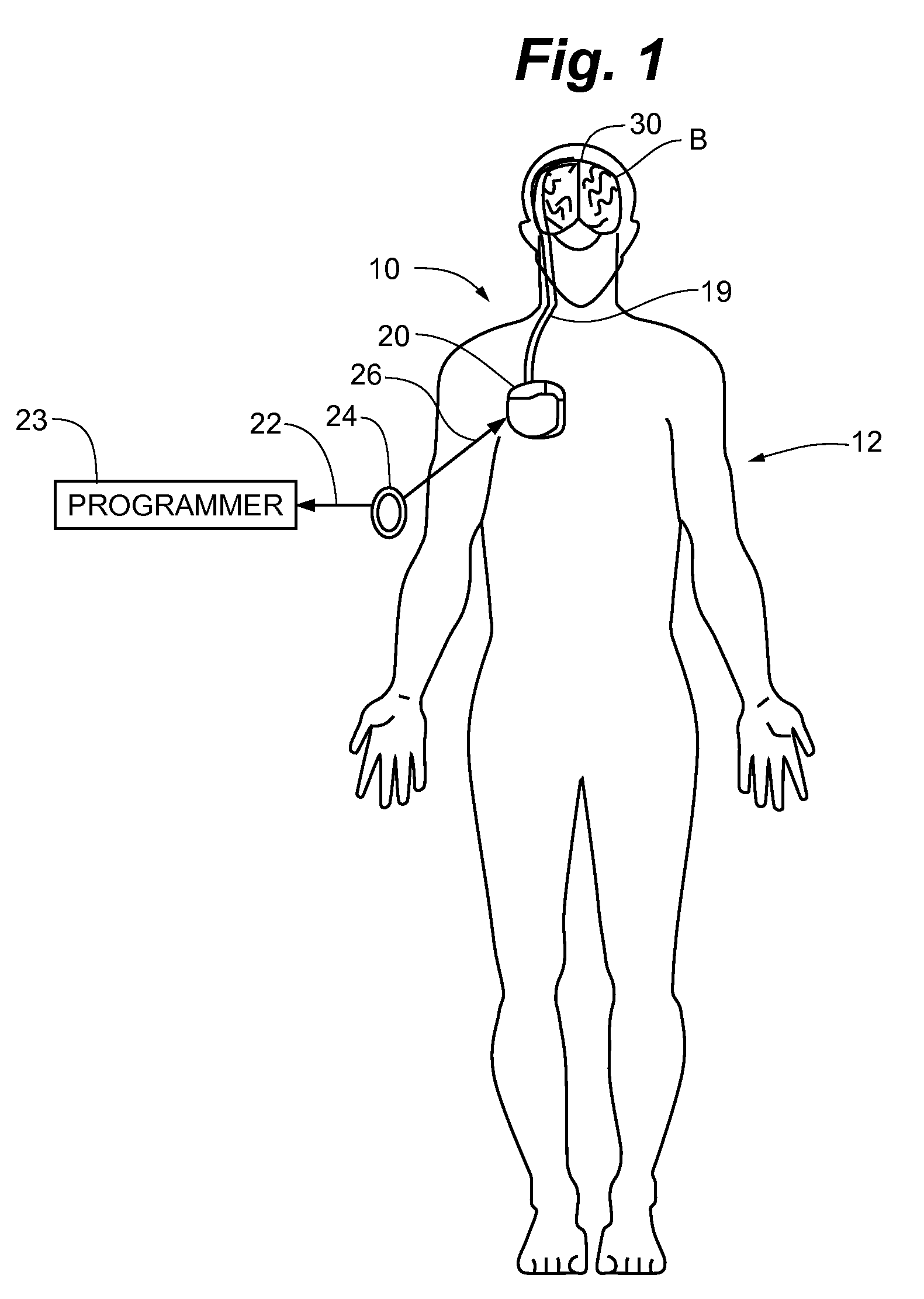 Method and apparatus for detection of nervous system disorders