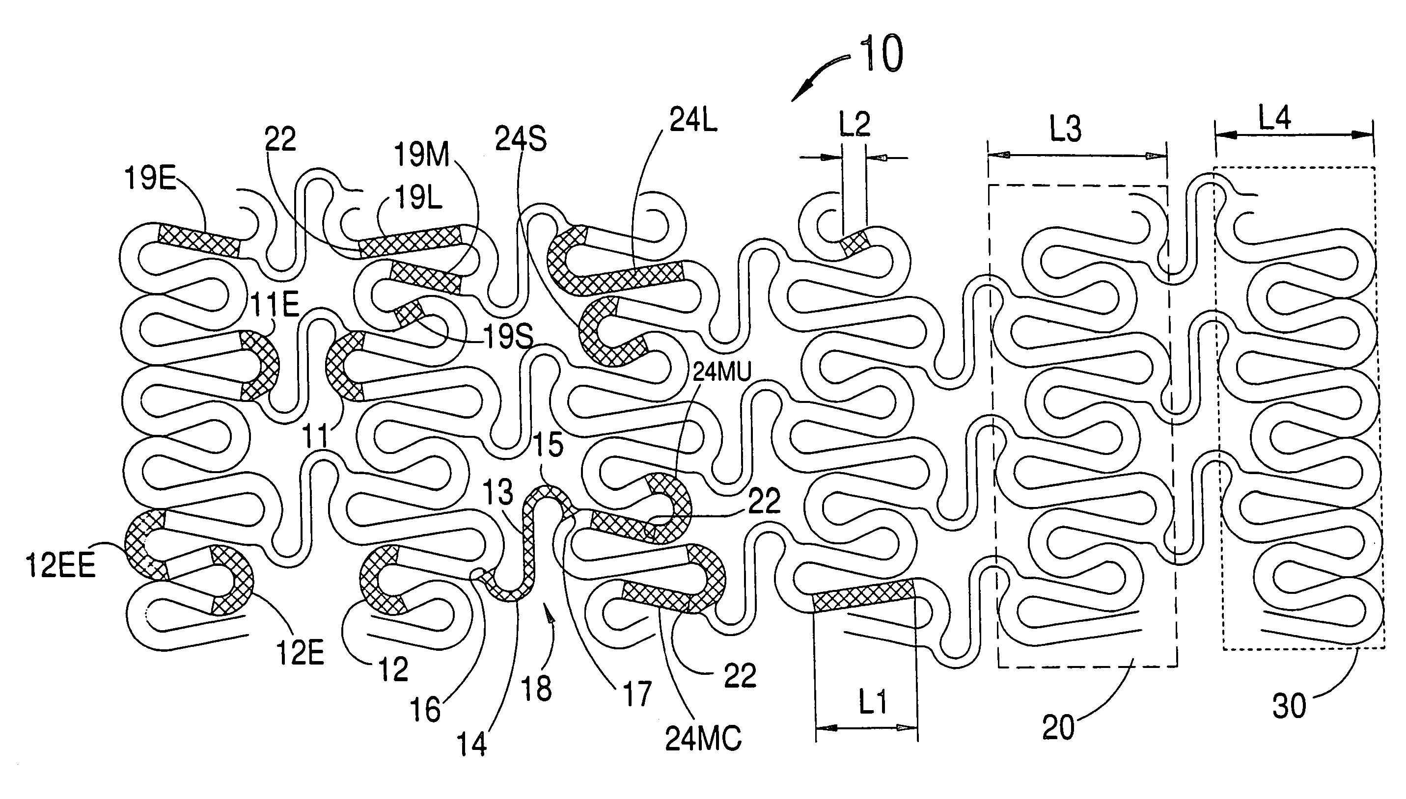 Hybrid stent