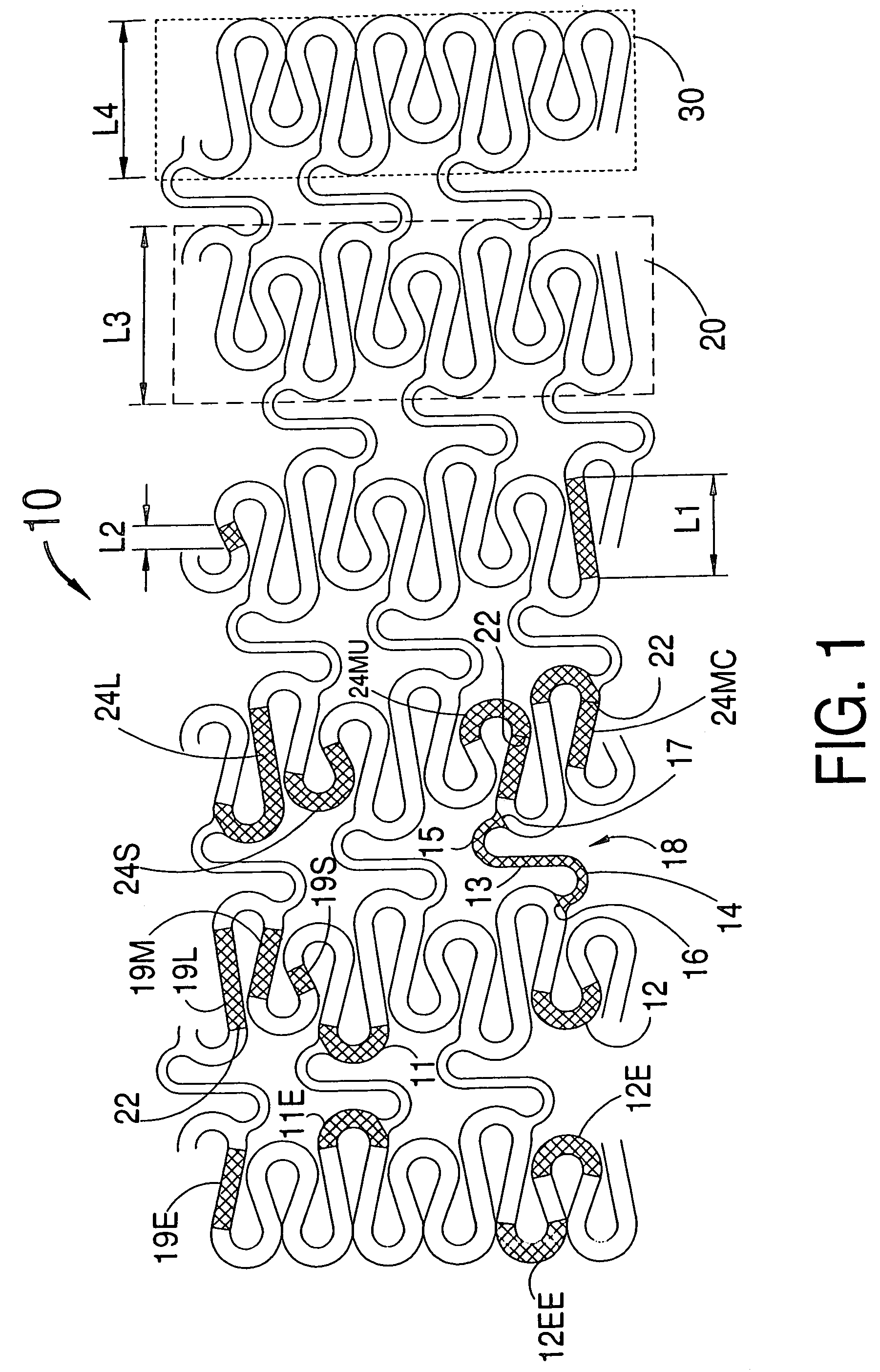 Hybrid stent