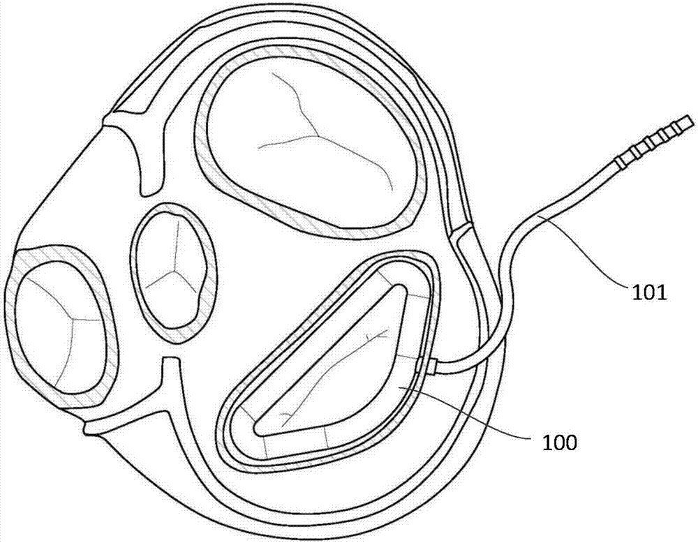 A mitral annuloplasty ring