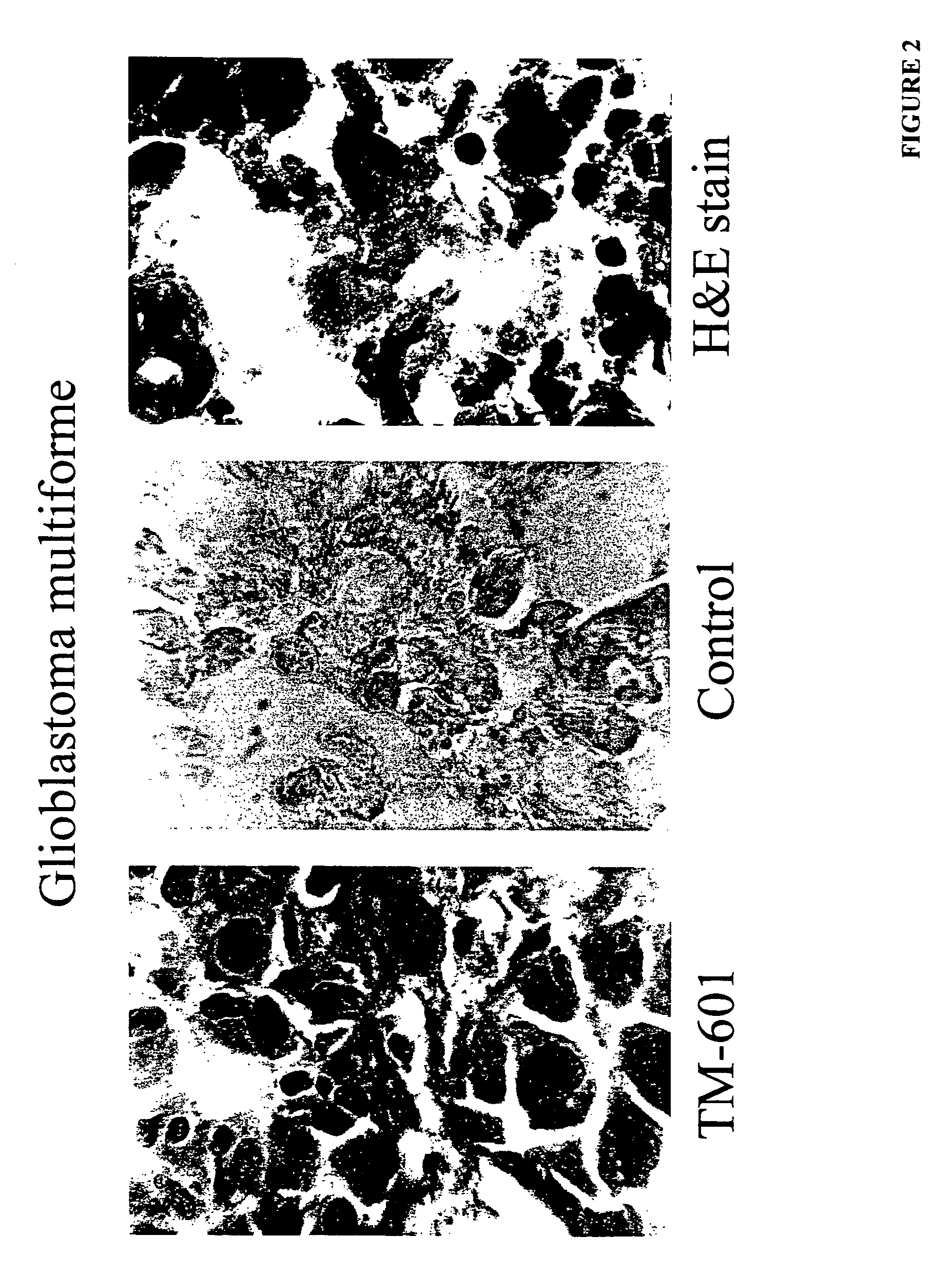 Diagnosis and treatment of neuroectodermal tumors