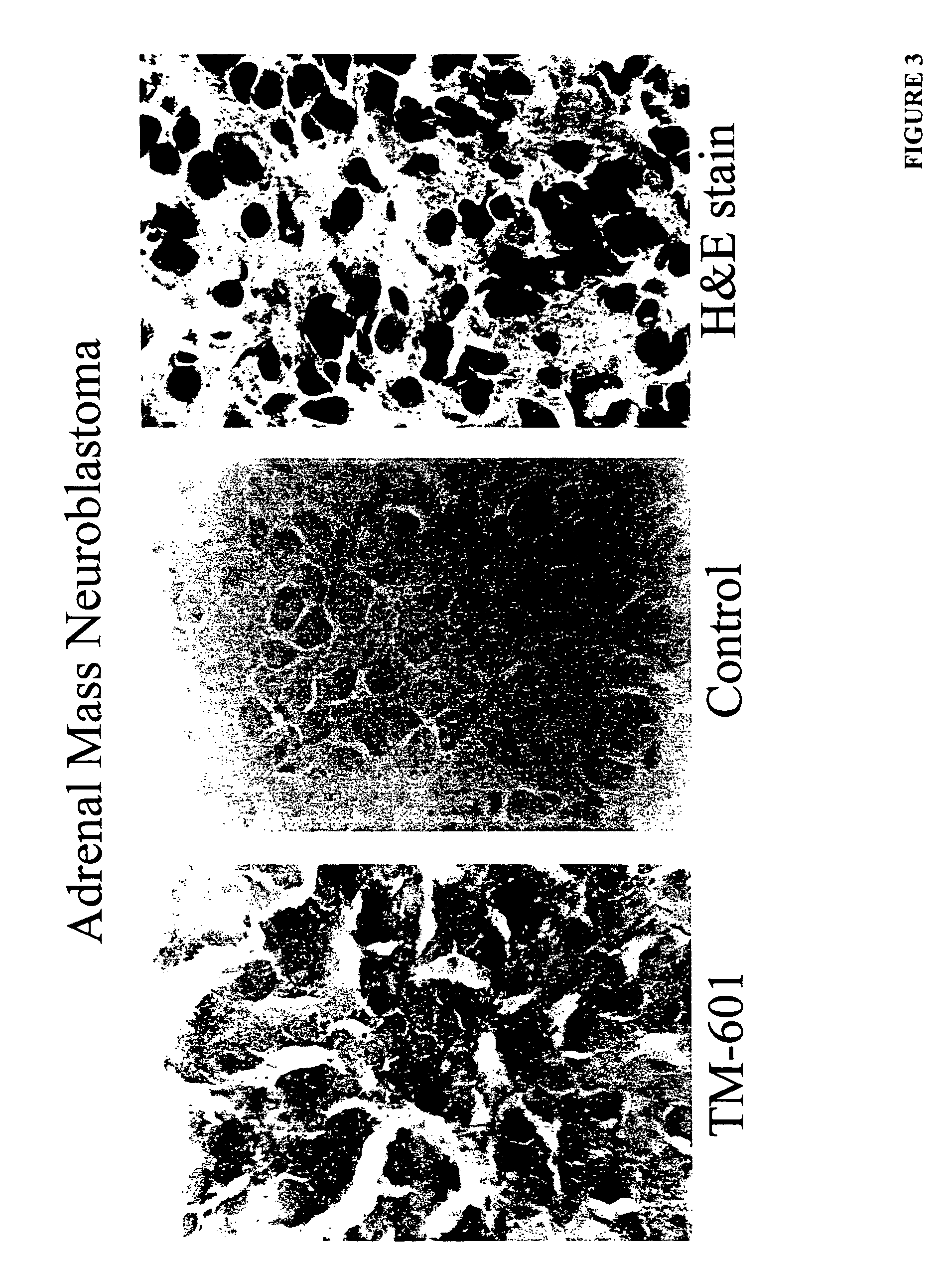 Diagnosis and treatment of neuroectodermal tumors