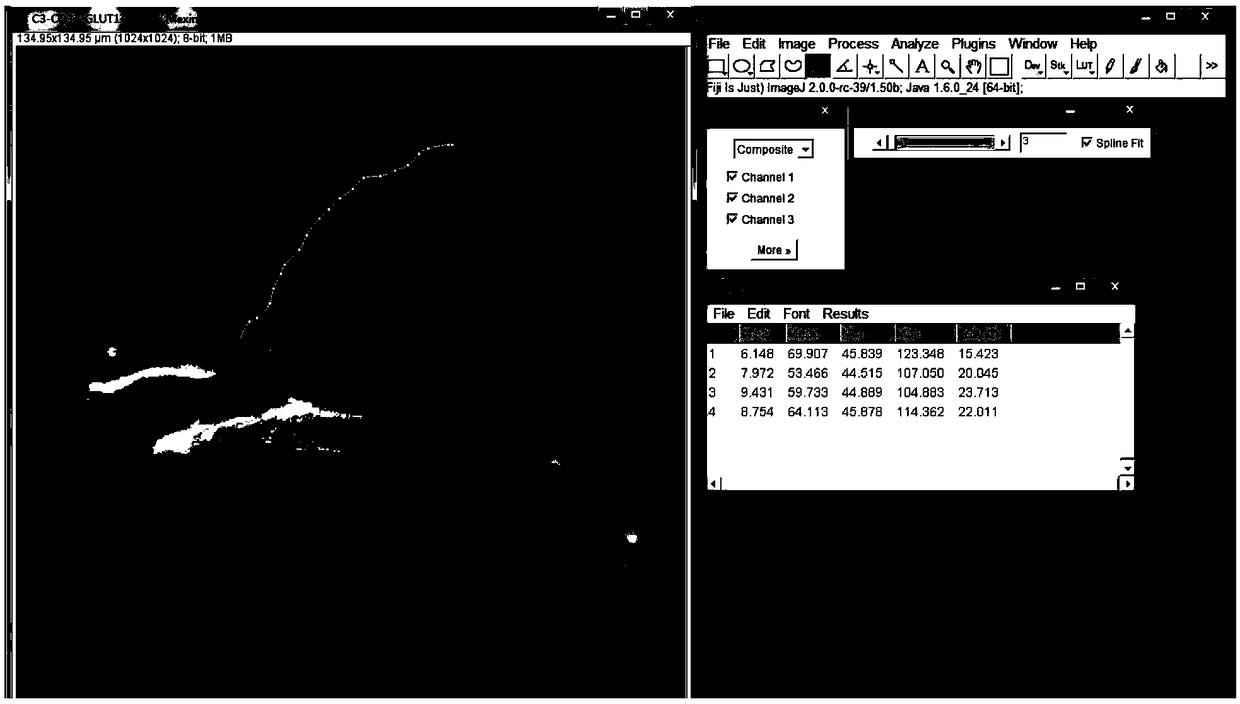 A kit for predicting the risk of pancreatic cancer postoperative recurrence