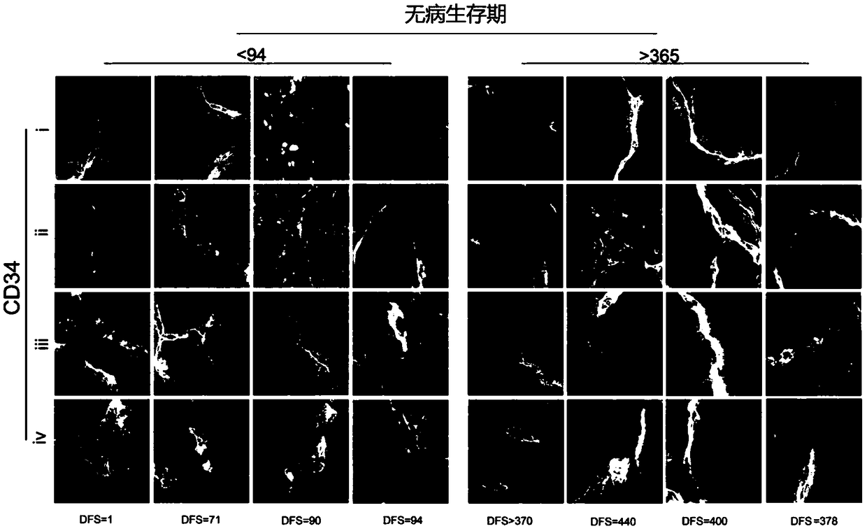 A kit for predicting the risk of pancreatic cancer postoperative recurrence