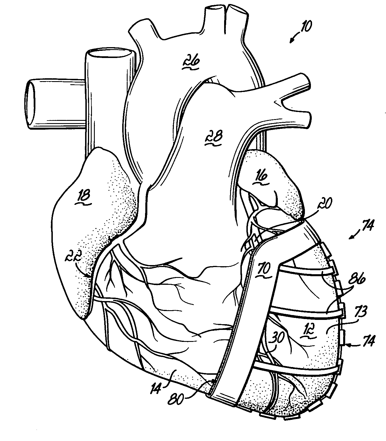 Heart wall actuation system for the natural heart with shape limiting elements