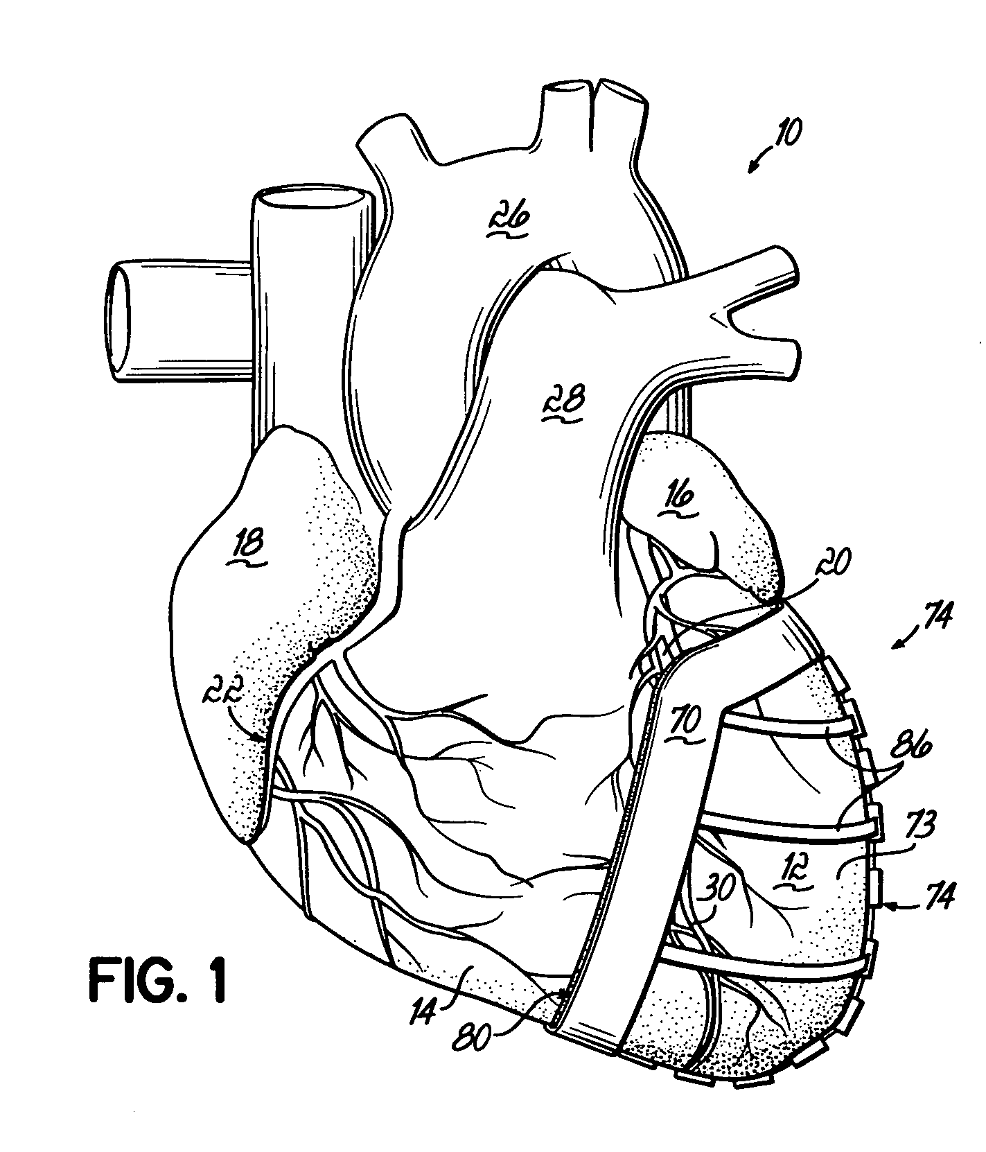 Heart wall actuation system for the natural heart with shape limiting elements