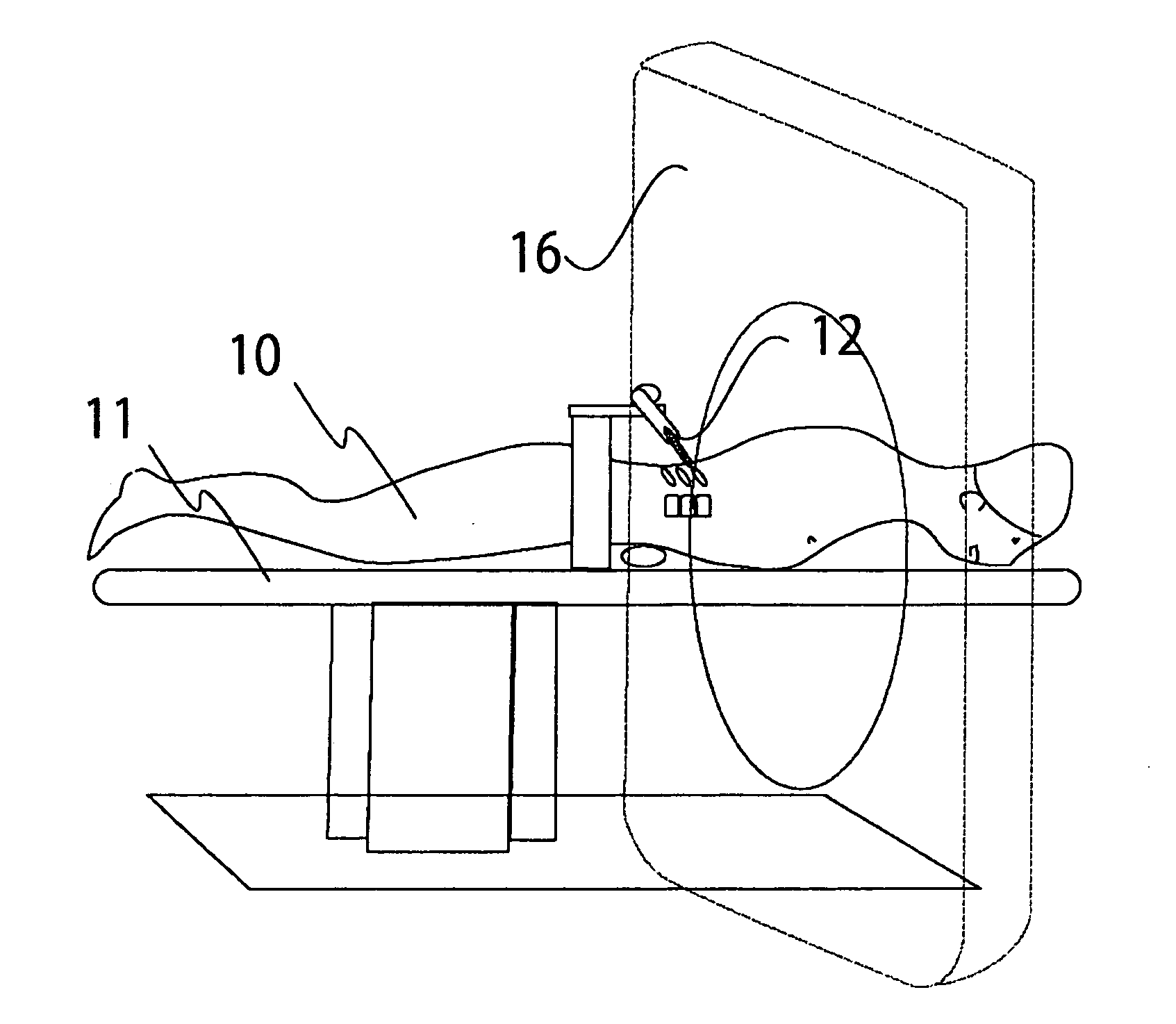 Technique and device for laminar osteotomy and laminoplasty