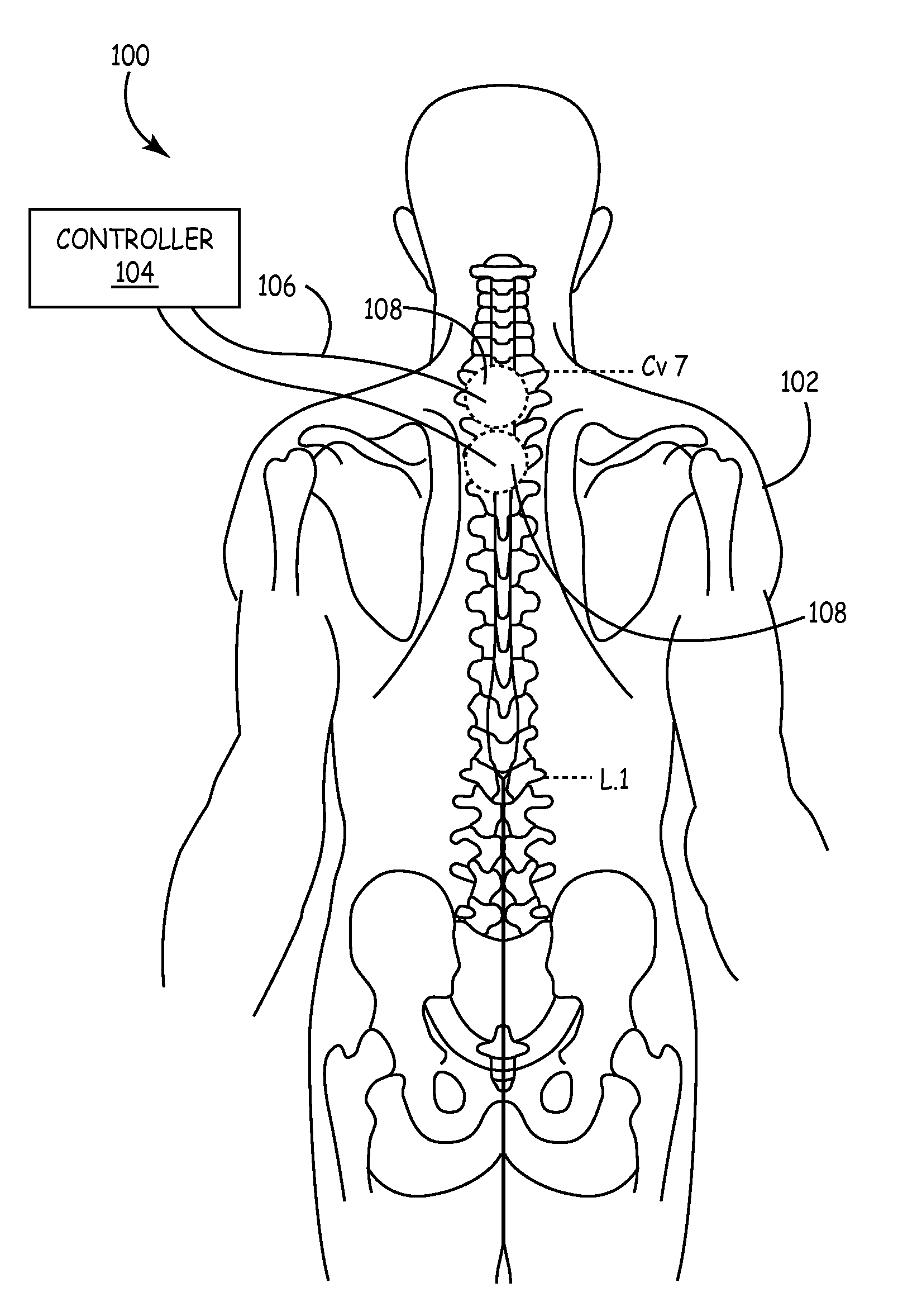 Methods and apparatus for sensing cardiac activity via neurological stimulation therapy system or medical electrical lead