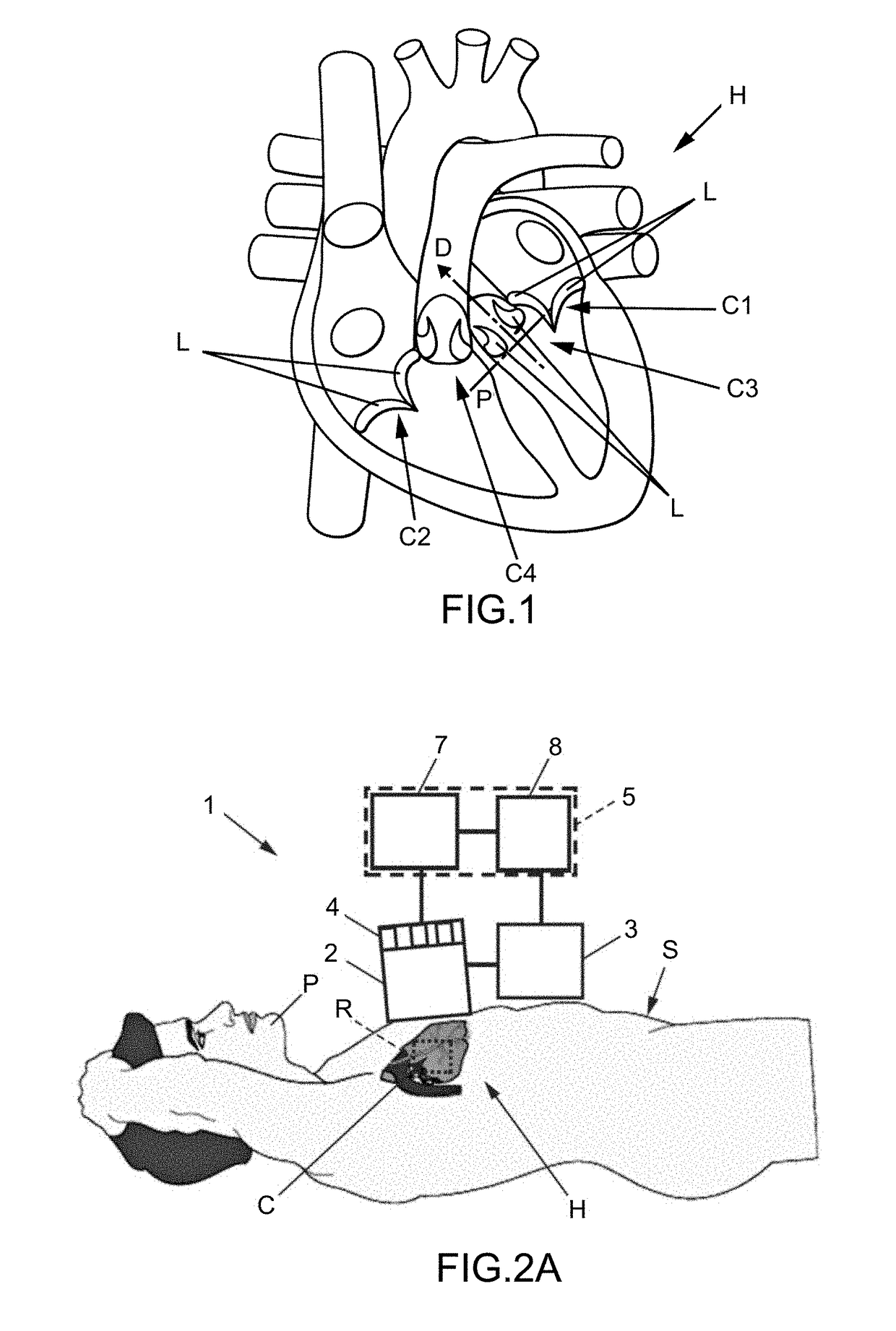 Method and apparatus for treating valvular disease