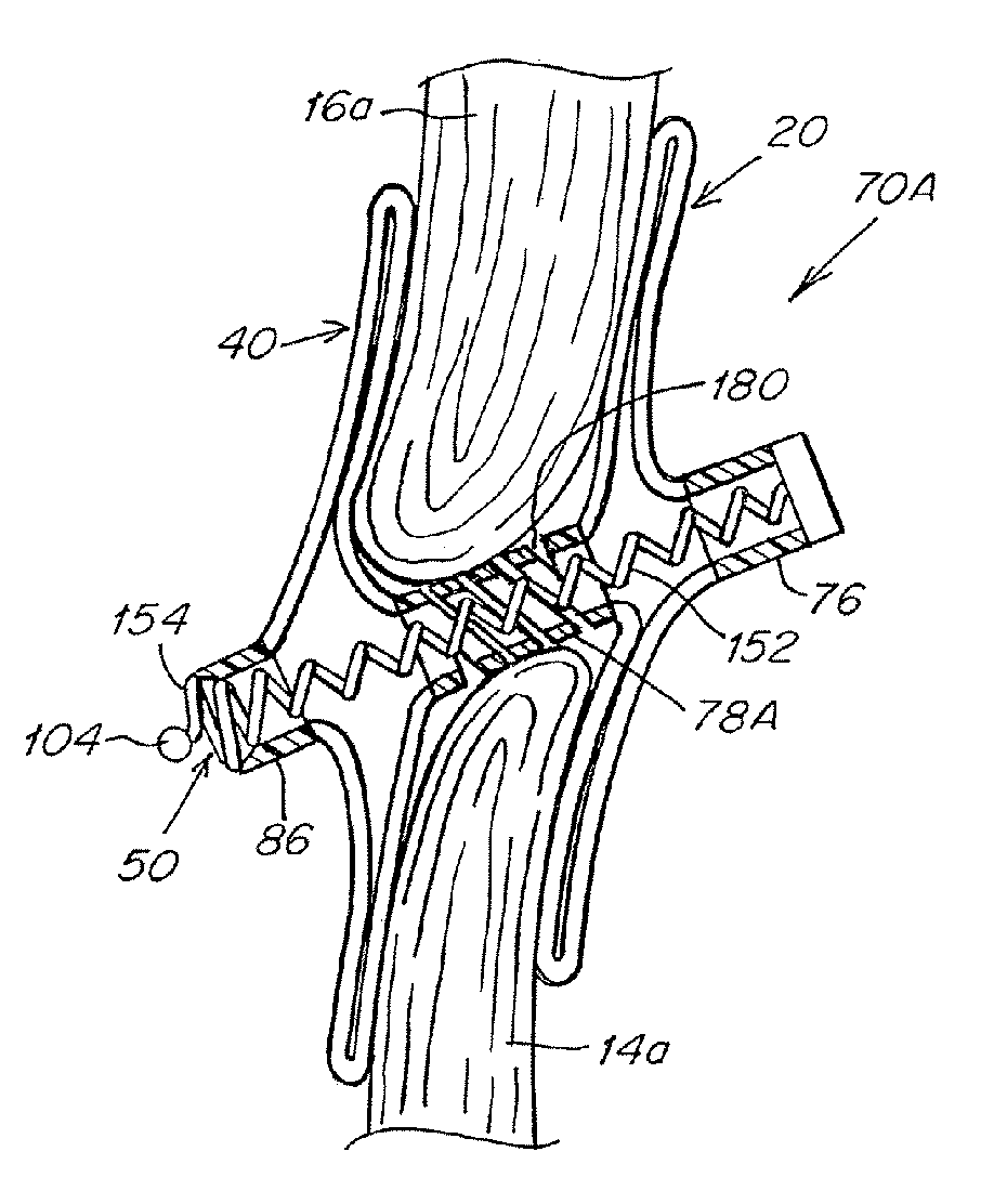 Adjustable length patent foramen ovale (PFO) occluder and catch system