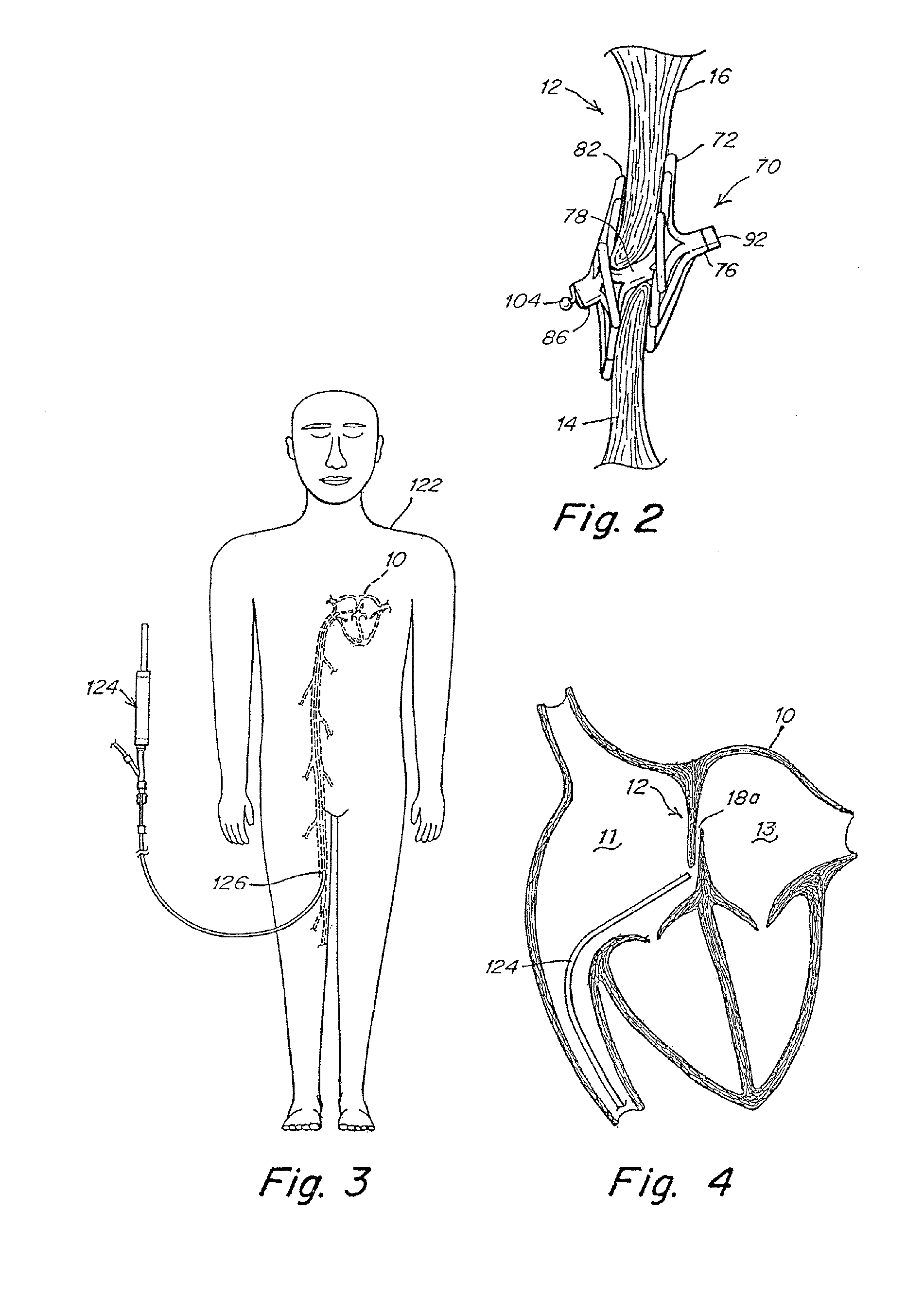 Adjustable length patent foramen ovale (PFO) occluder and catch system