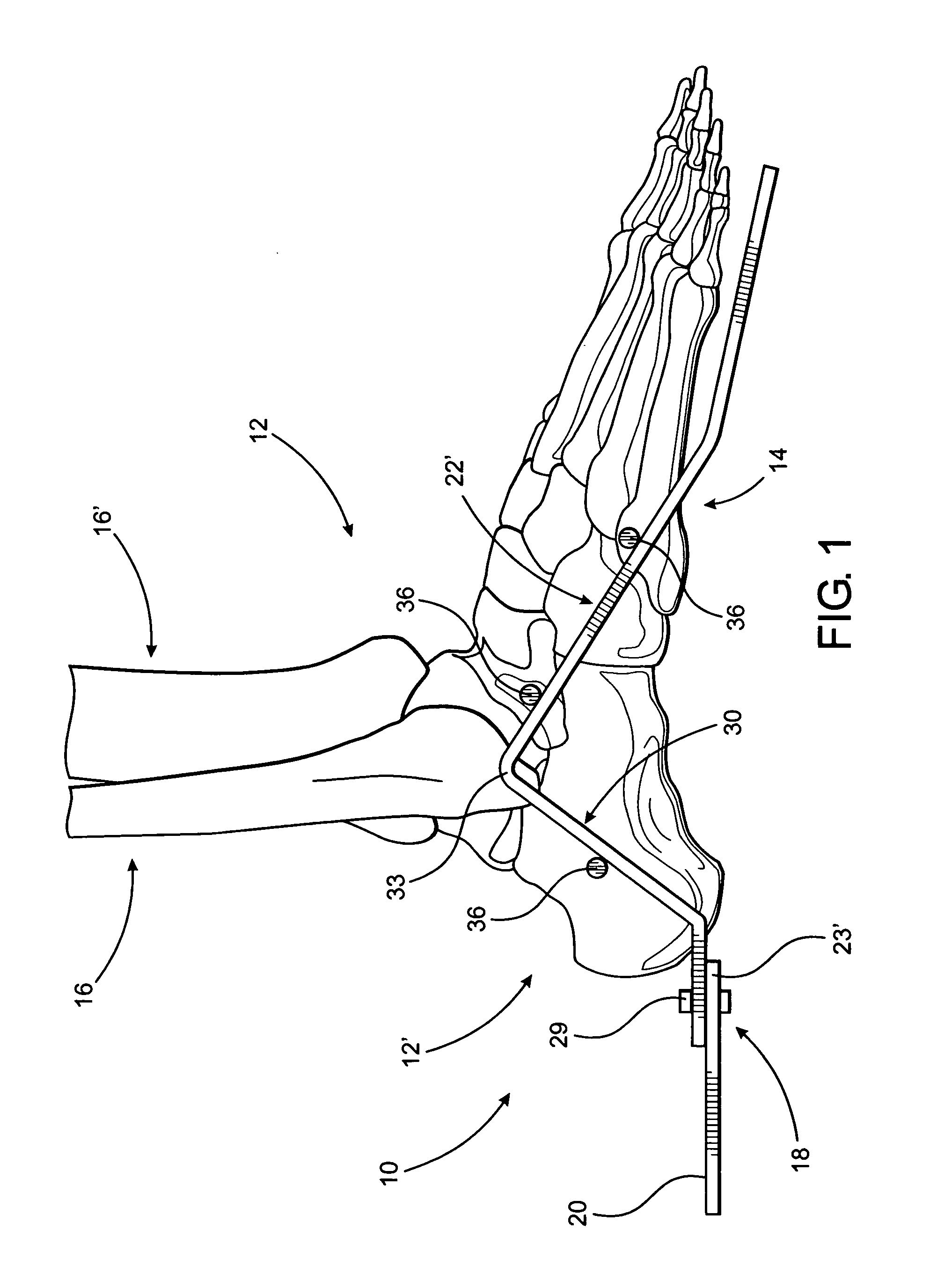 External fixator assembly