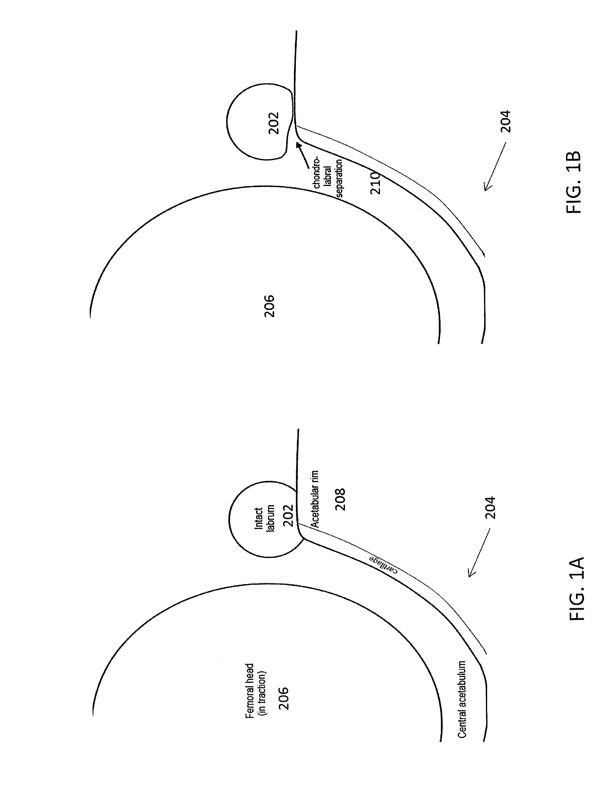 Suture passer and method for hip labrum repair