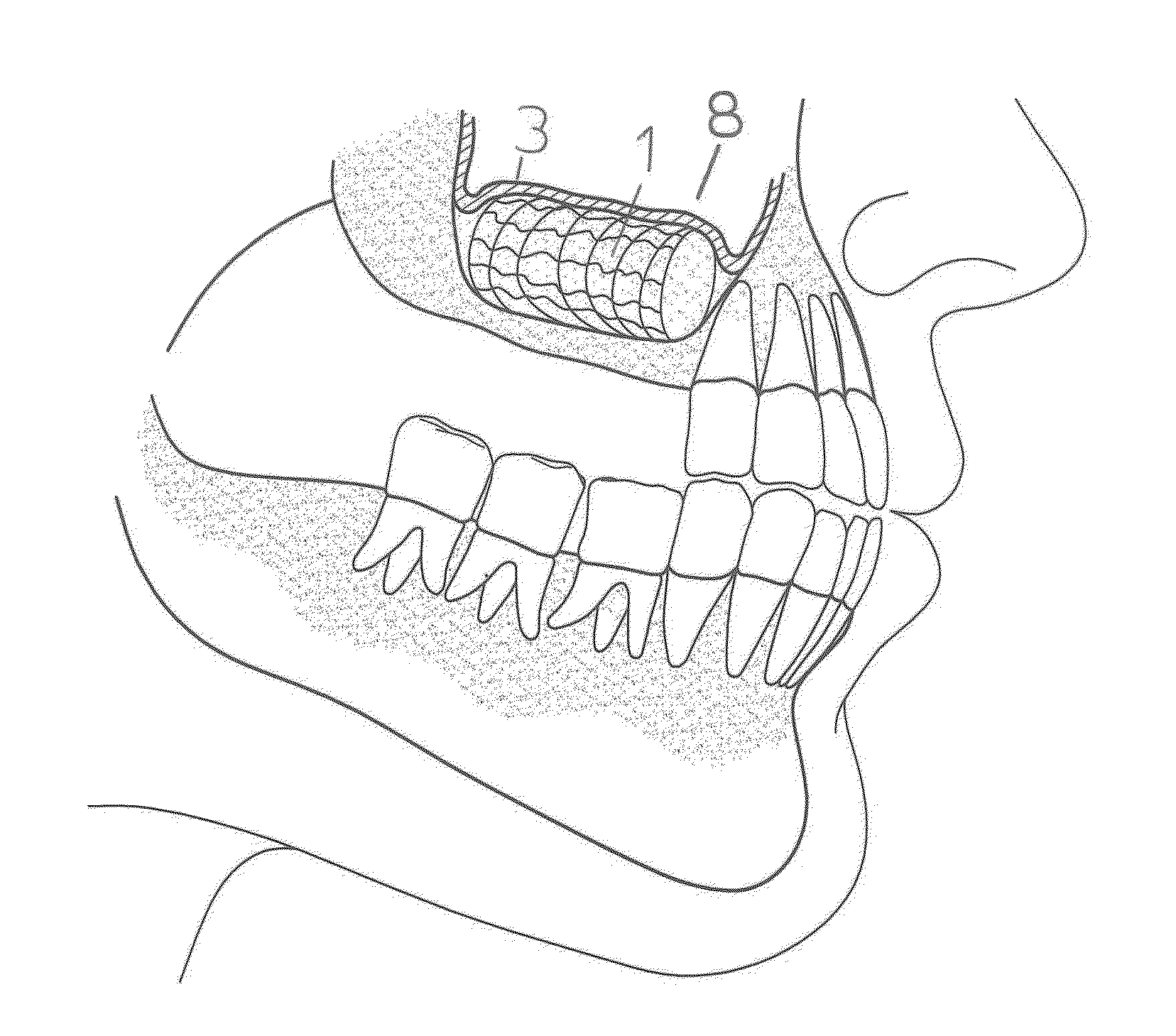 Method for maxillary sinus floor elevation