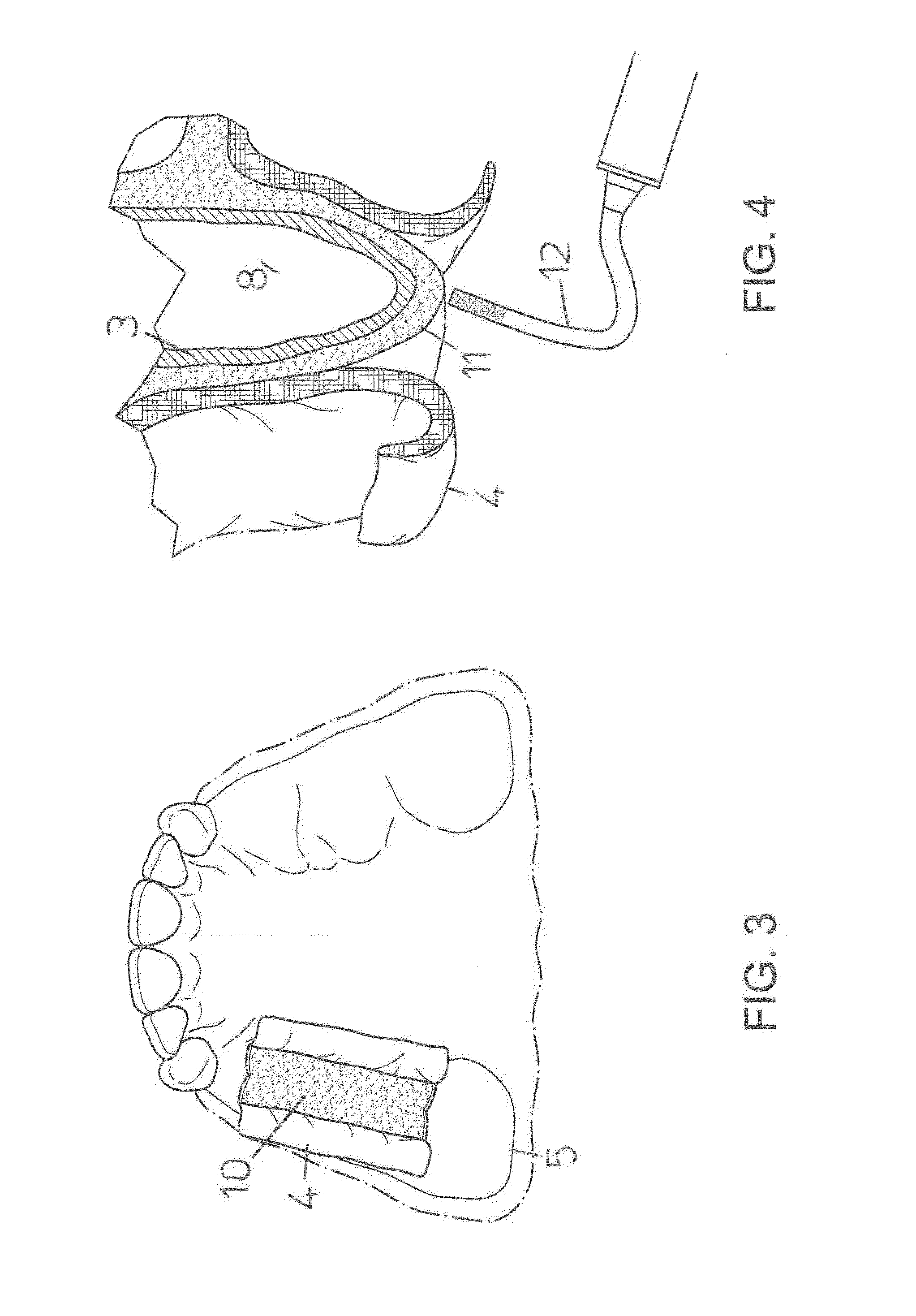 Method for maxillary sinus floor elevation