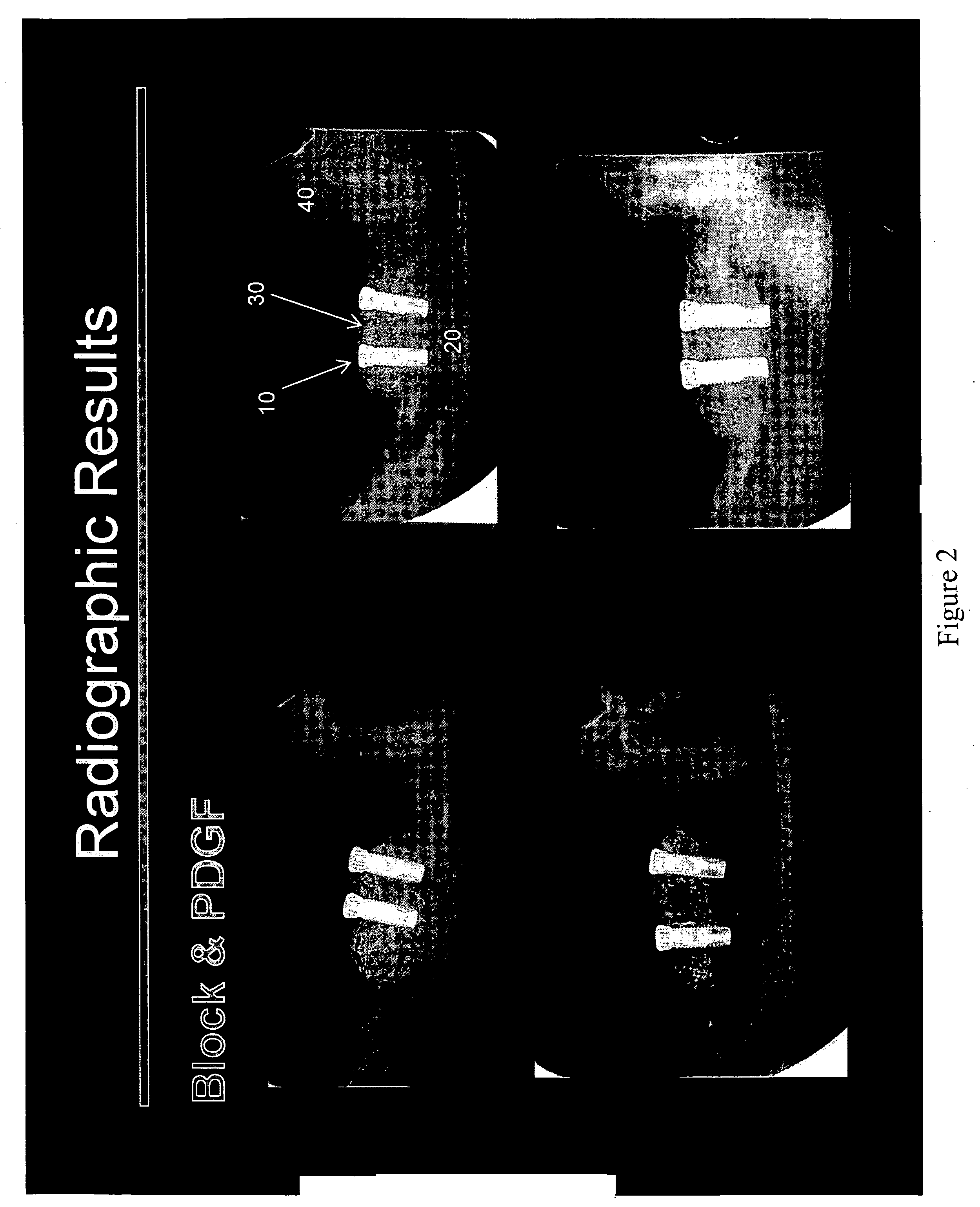 Maxillofacial bone augmentation using rhPDGF-BB and a biocompatible matrix