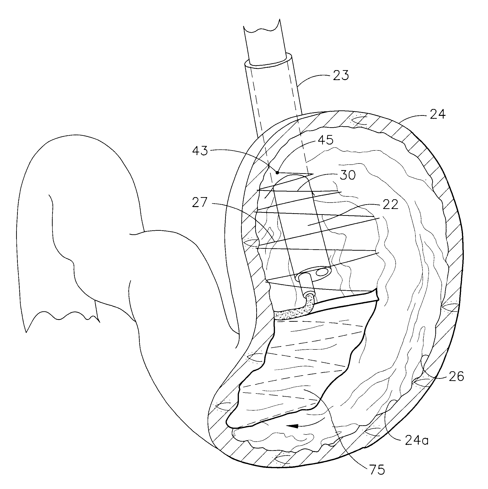 Expanding Adhesive Foam Structure to Reduce Stomach Volume