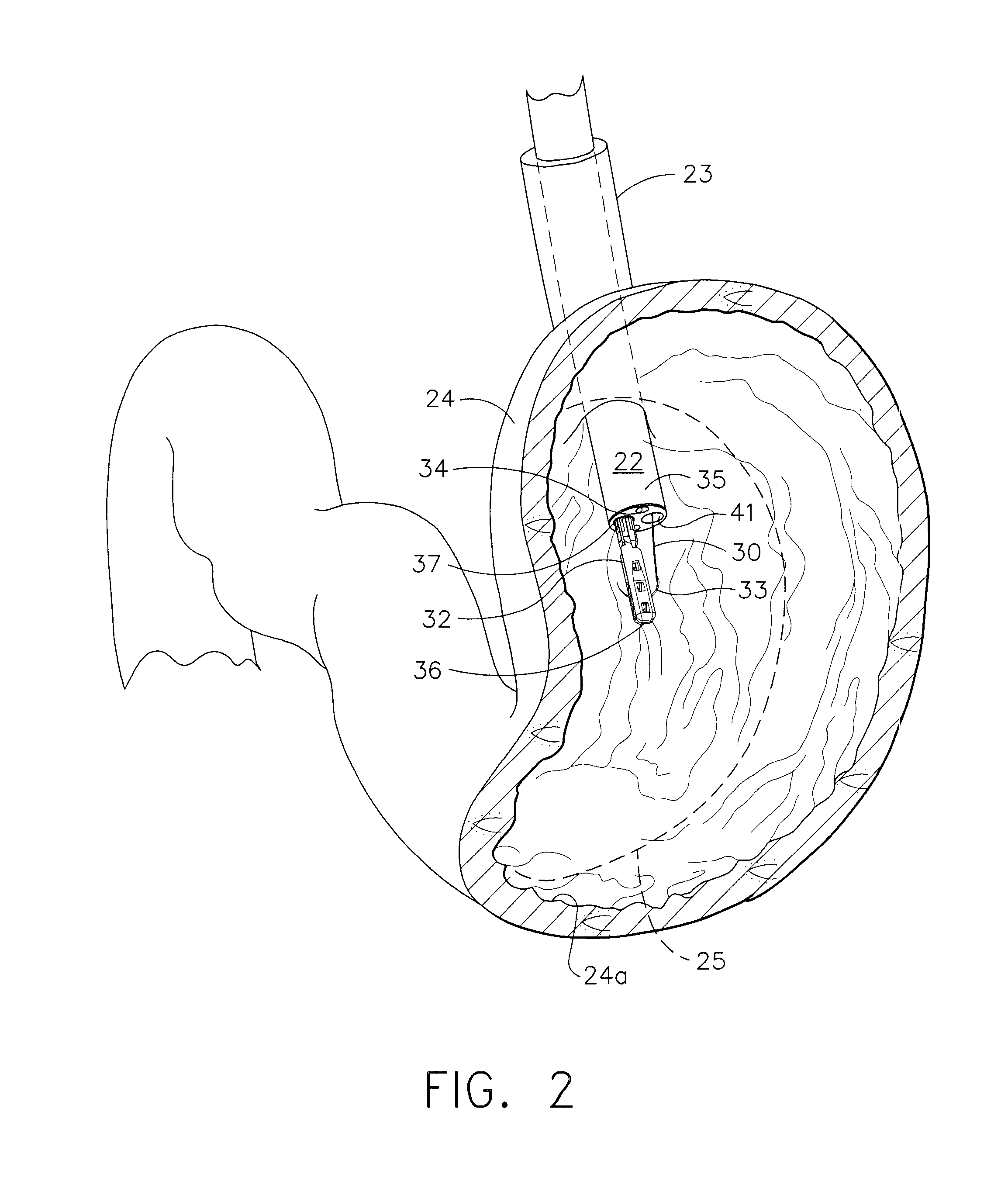 Expanding Adhesive Foam Structure to Reduce Stomach Volume