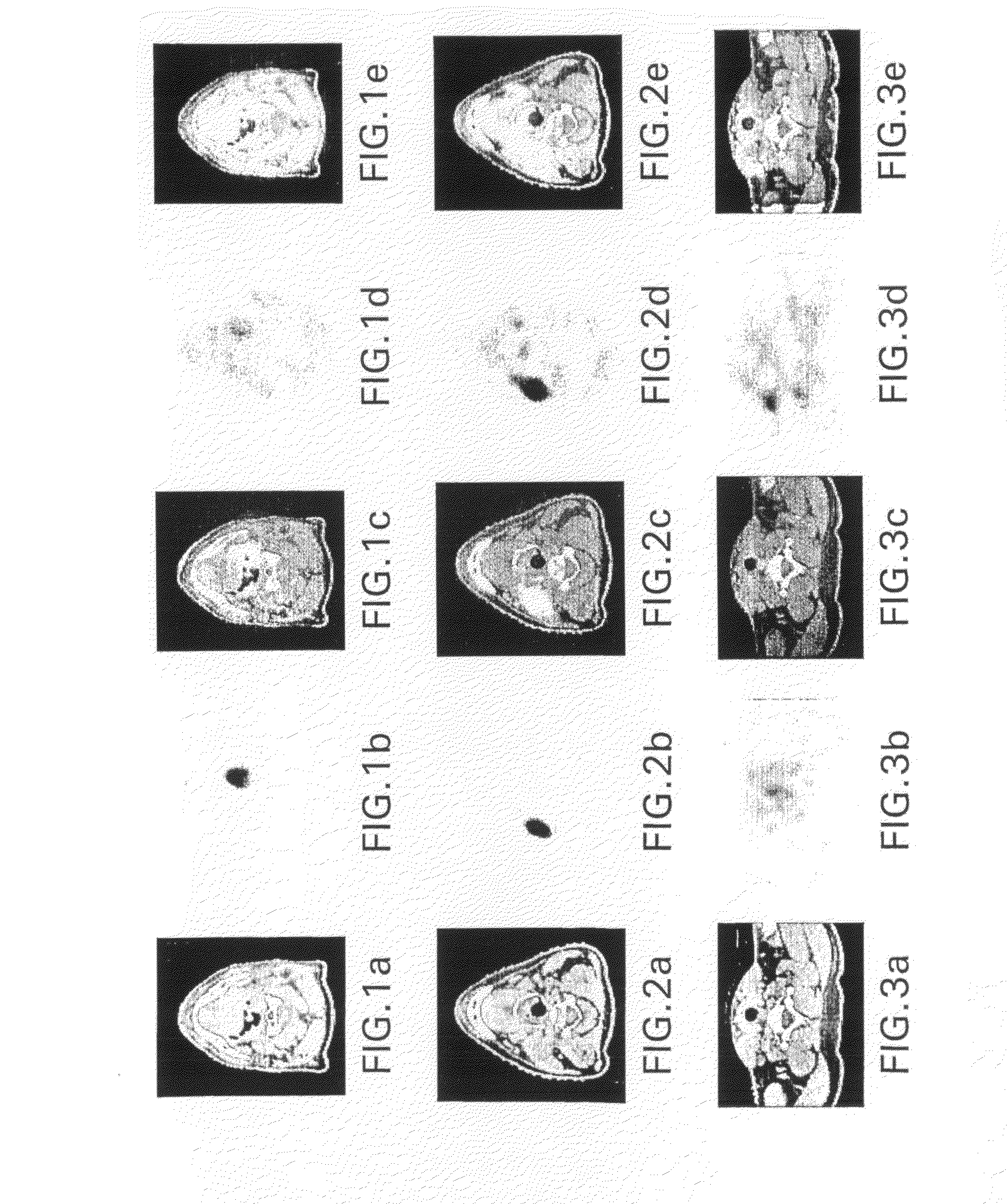 Radiolabeled 1-acetate pet imaging for radiotherapy in head and neck cancer