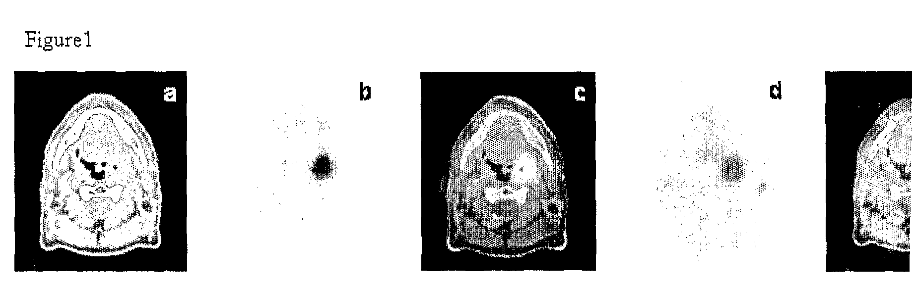 Radiolabeled 1-acetate pet imaging for radiotherapy in head and neck cancer